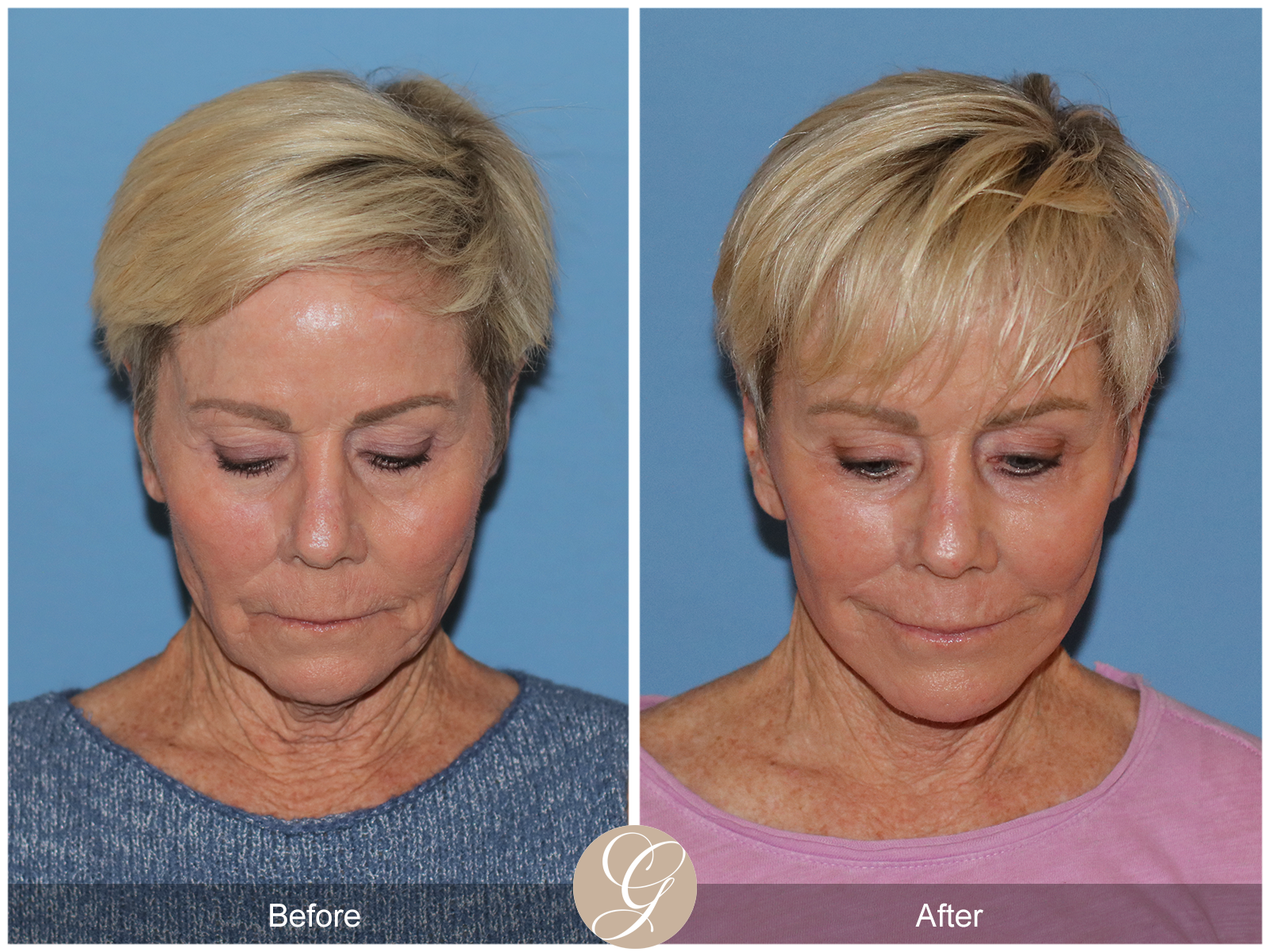 Preservation Deep Plane Facelift Case 28 Image