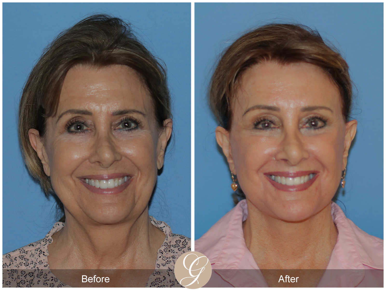 Preservation Deep Plane Facelift Case 30 Image