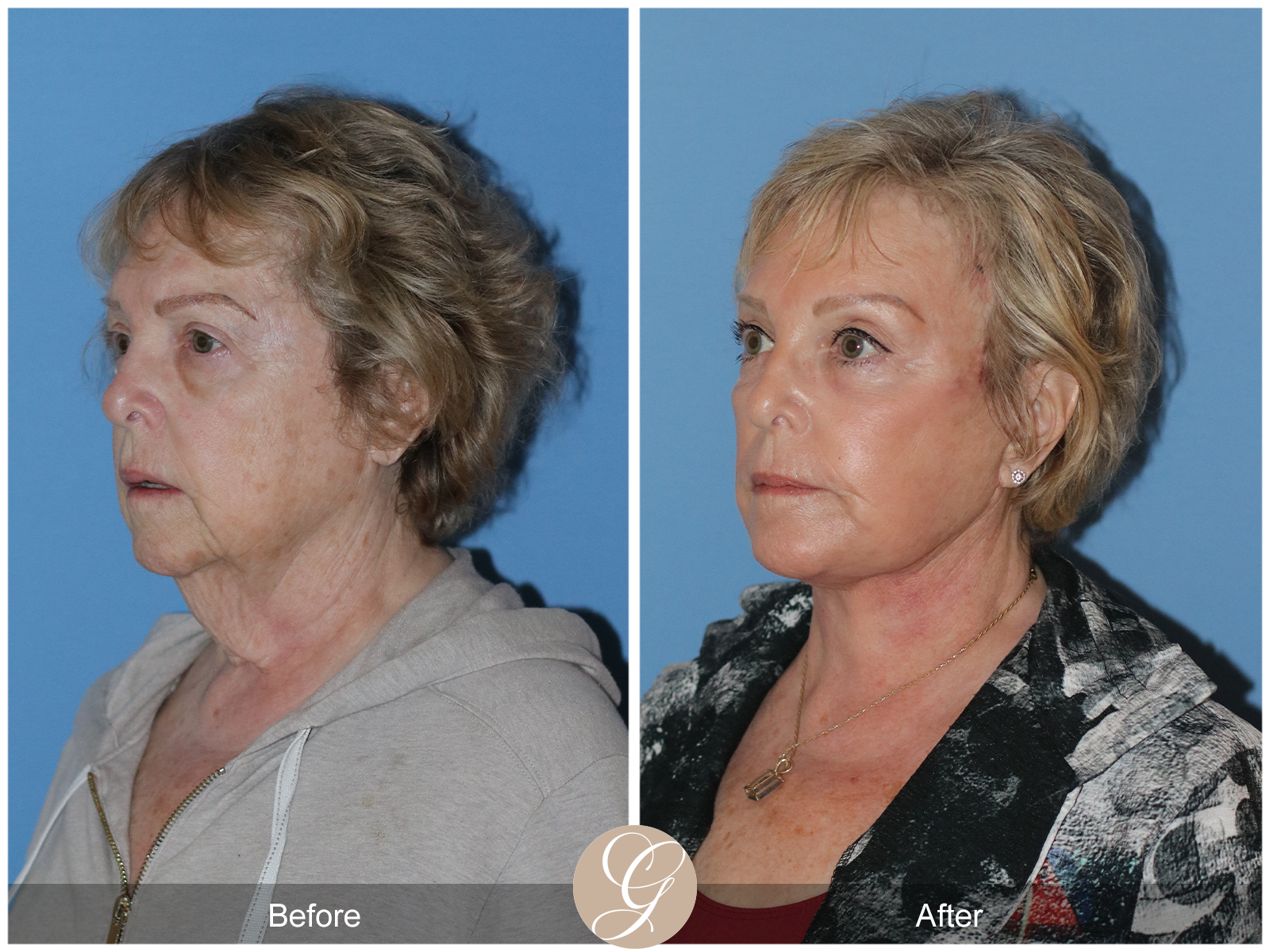 Preservation Deep Plane Facelift Case 31 Image