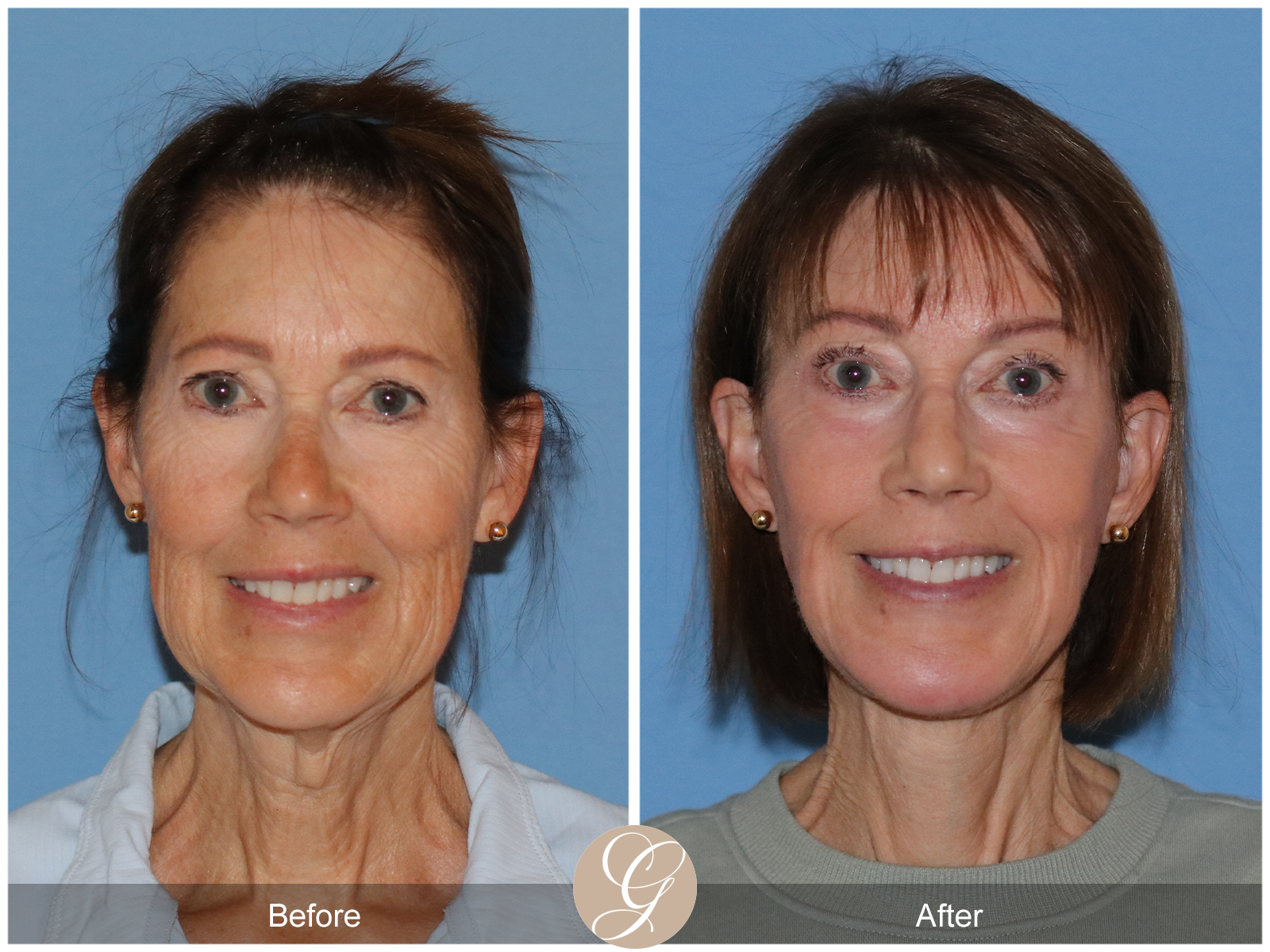 Preservation Deep Plane Facelift Case 32 Image