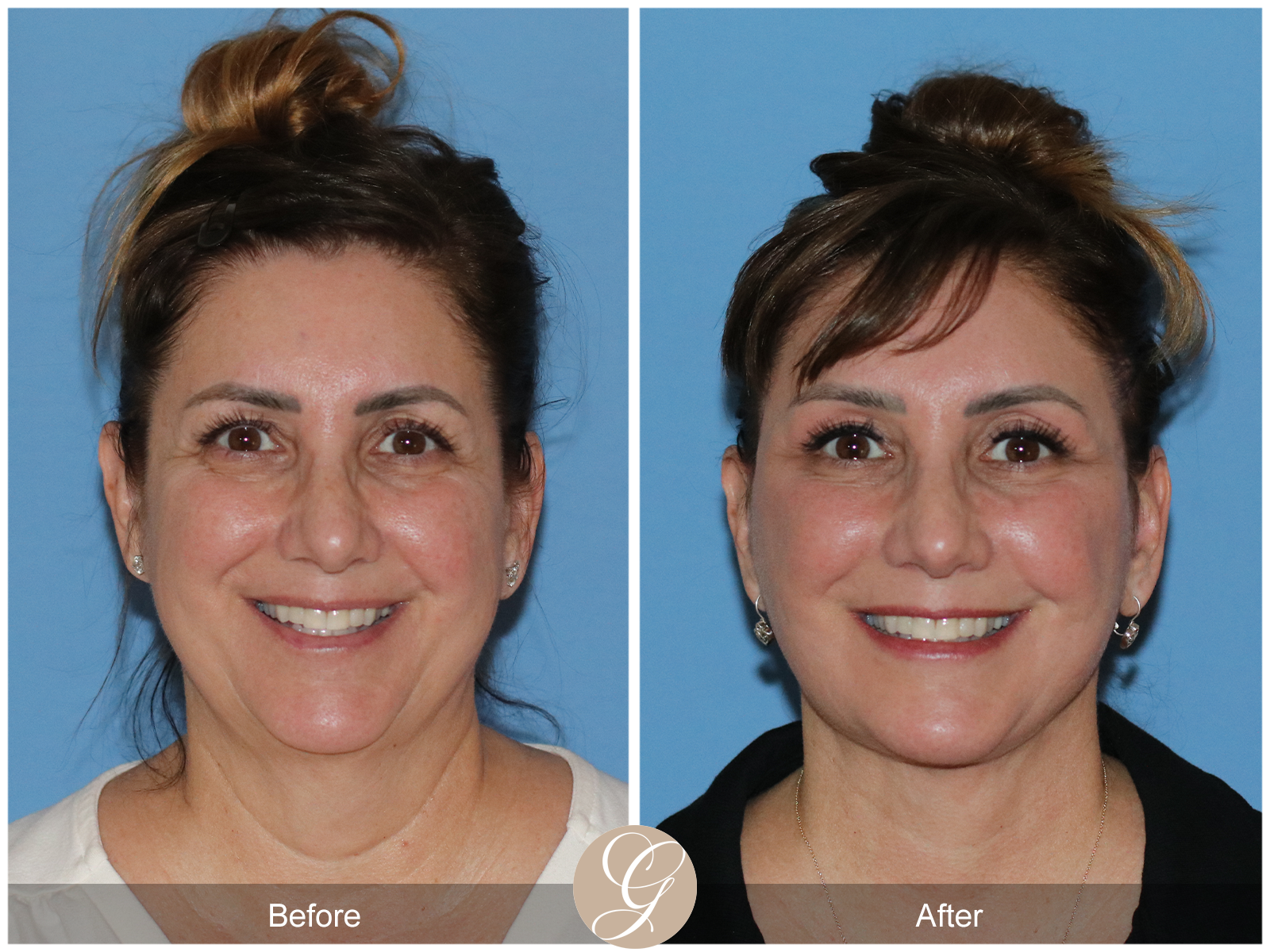 Preservation Deep Plane Facelift Case 33 Image