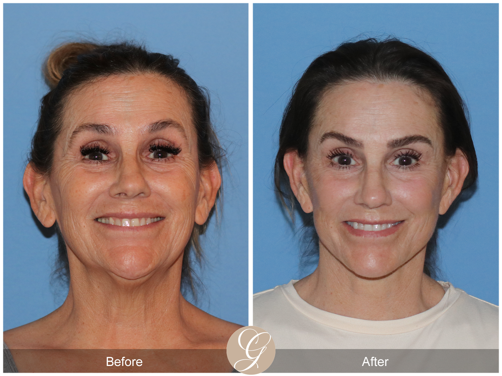 Deep Plane Facelift Case 25 Image