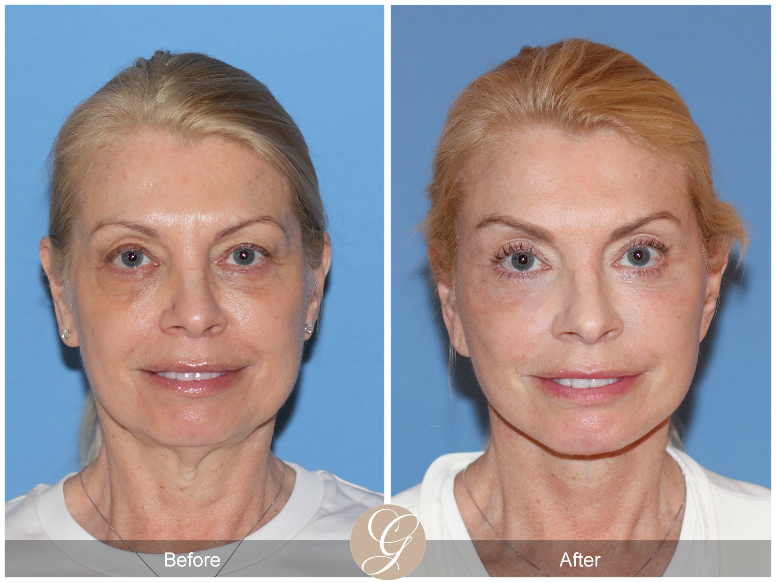 Preservation Deep Plane Facelift Case 26 Image