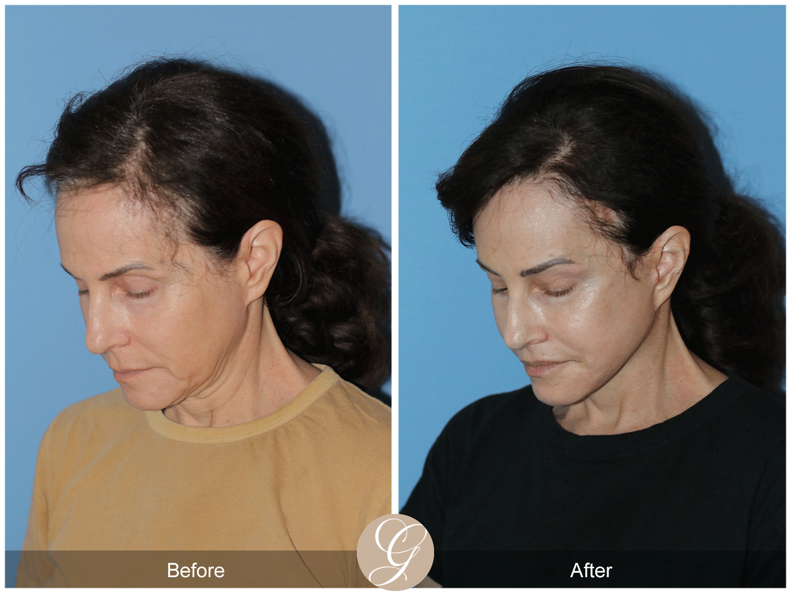 Preservation Deep Plane Facelift Case 29 Image