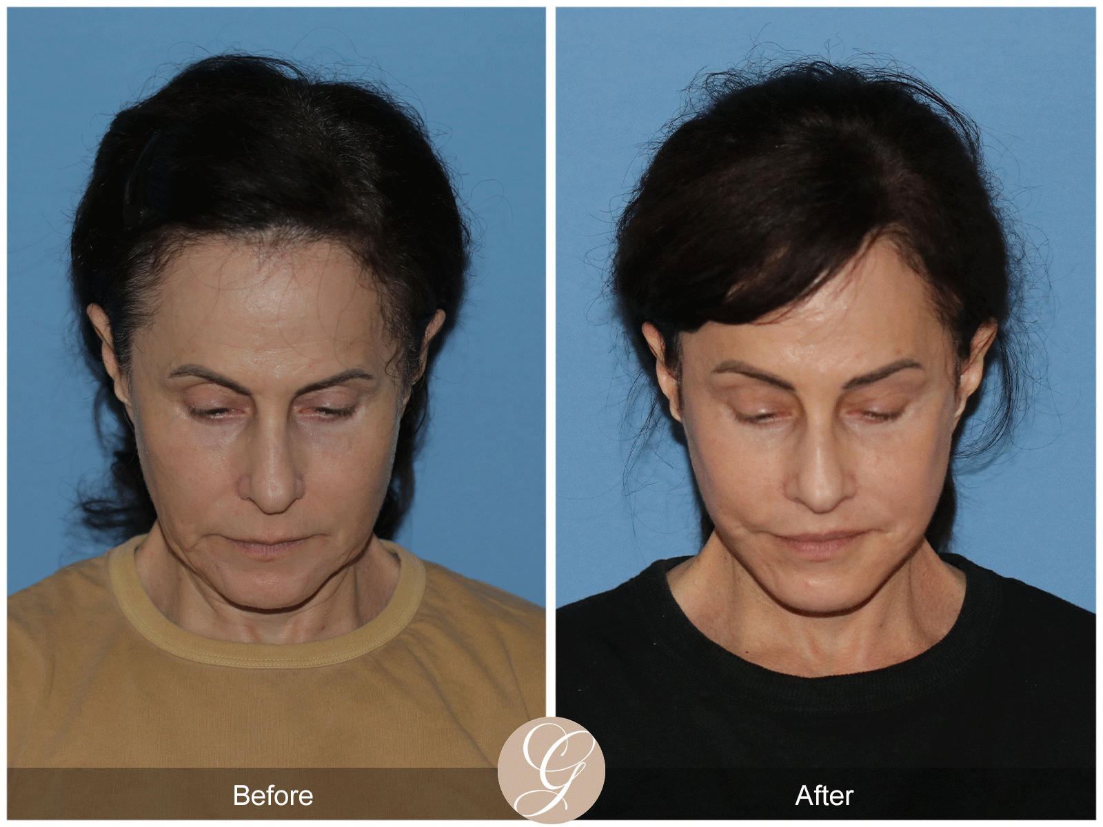 Preservation Deep Plane Facelift Case 29 Image