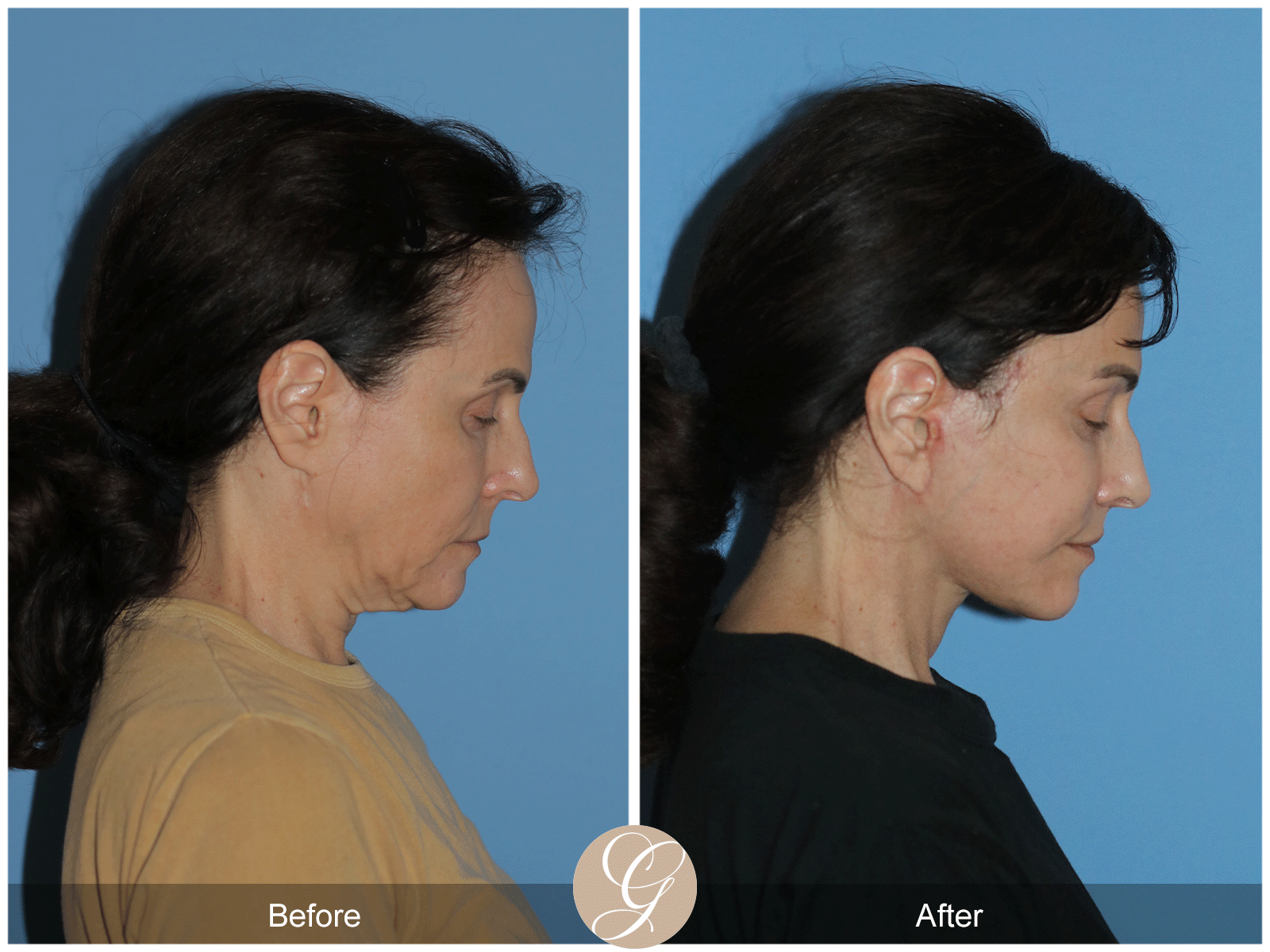 Preservation Deep Plane Facelift Case 29 Image