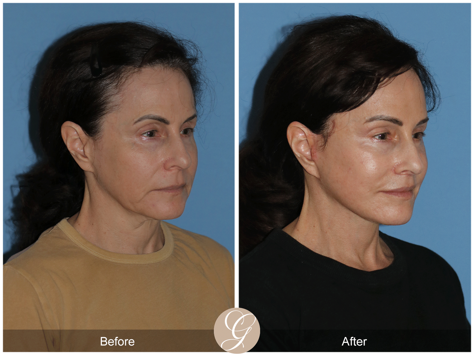 Preservation Deep Plane Facelift Case 29 Image