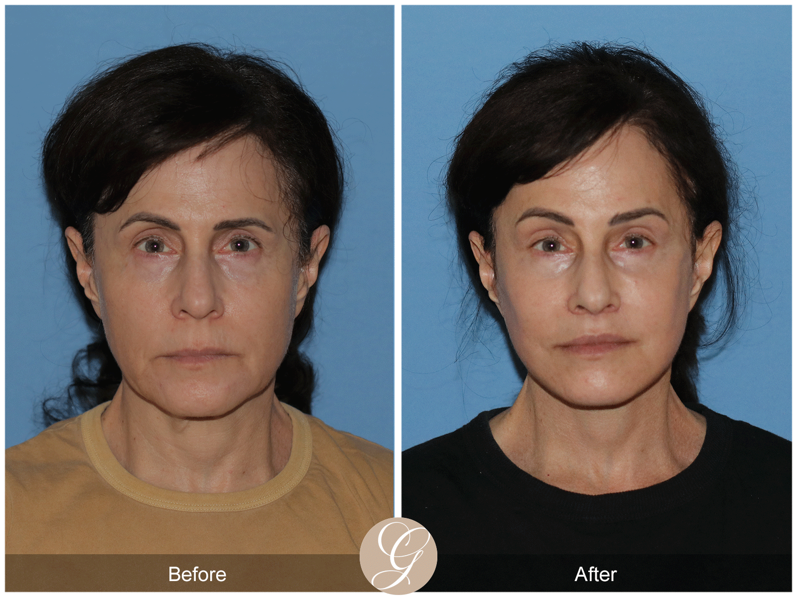 Preservation Deep Plane Facelift Case 29 Image