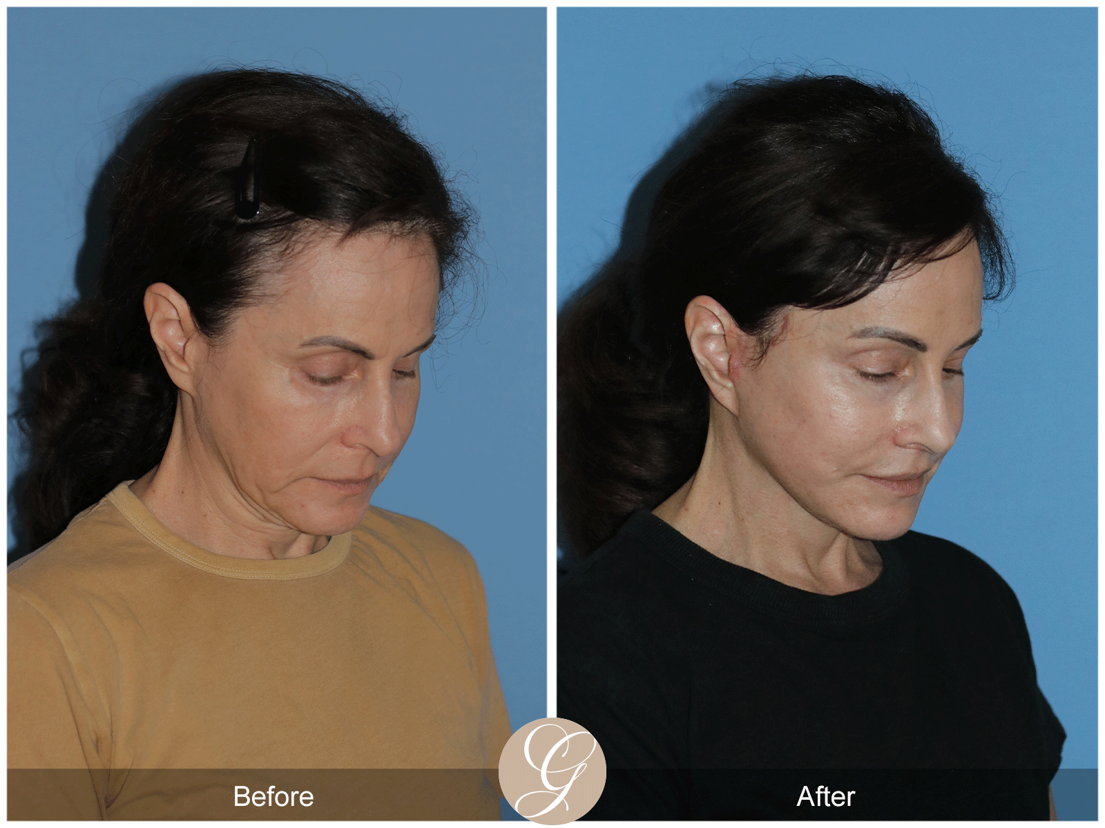 Preservation Deep Plane Facelift Case 29 Image