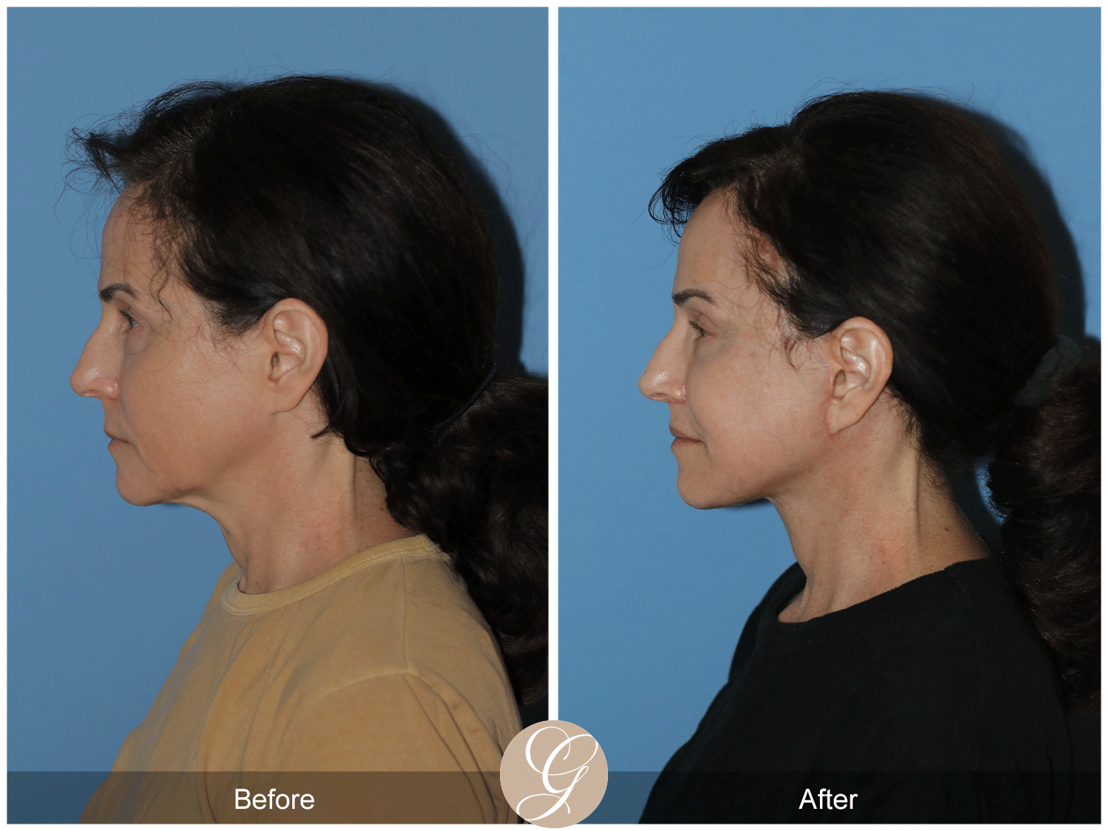 Preservation Deep Plane Facelift Case 29 Image