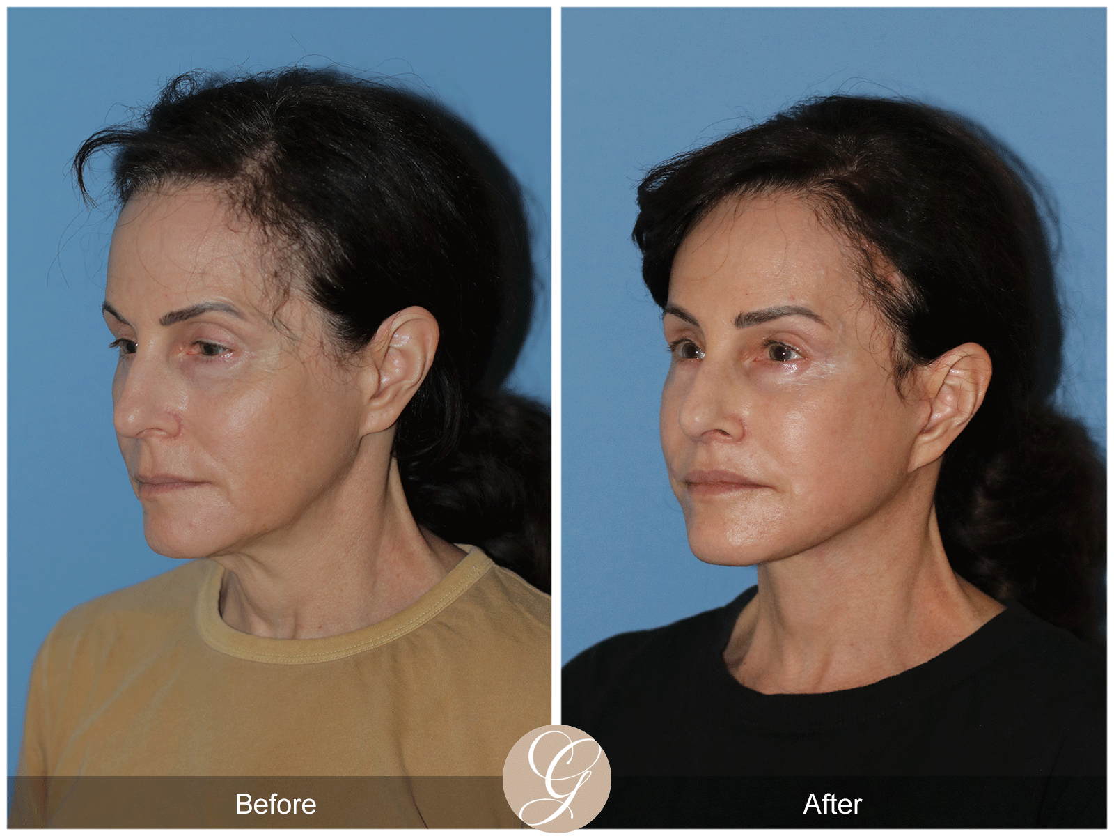 Preservation Deep Plane Facelift Case 29 Image