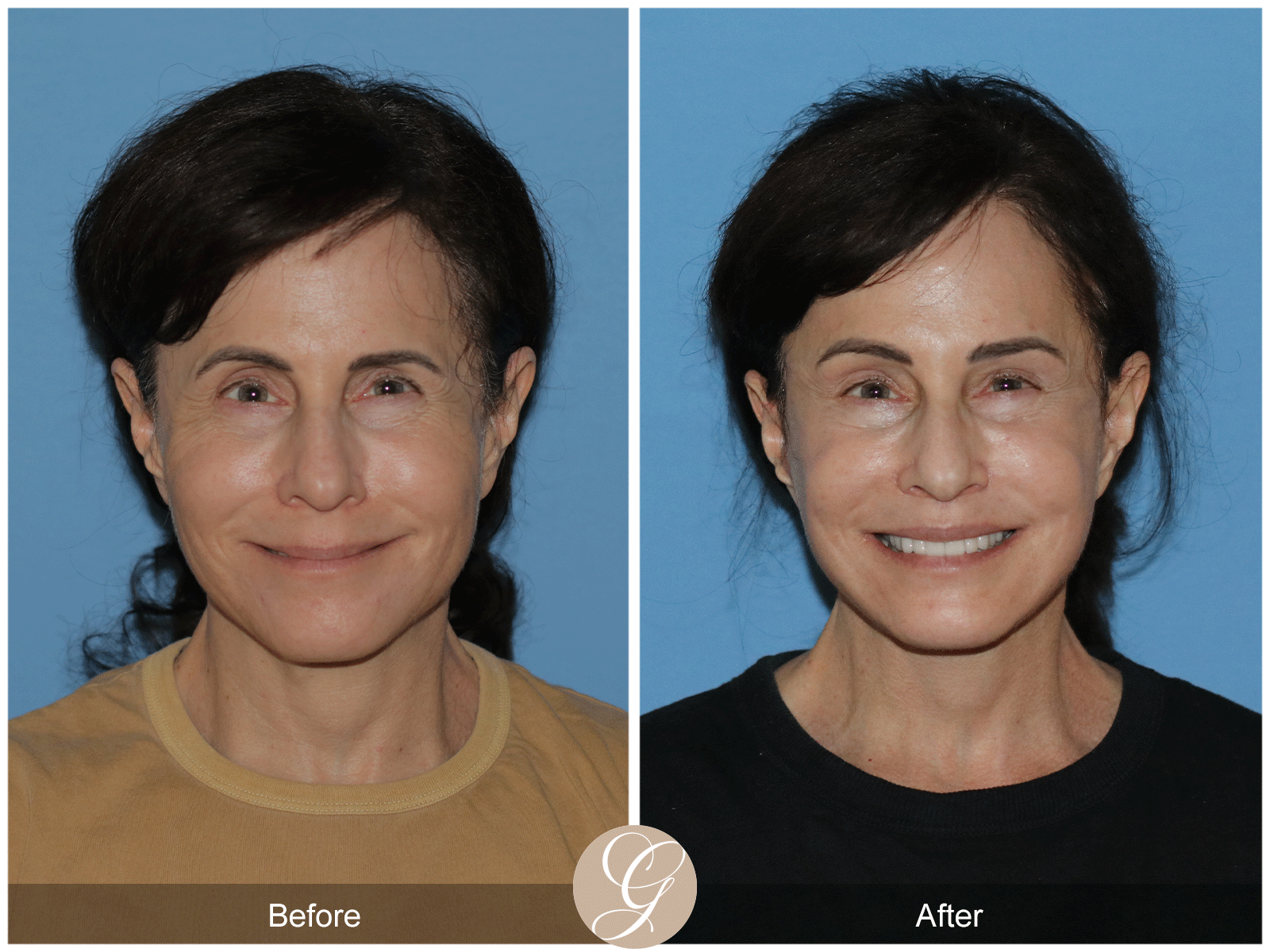 Preservation Deep Plane Facelift Case 29 Image