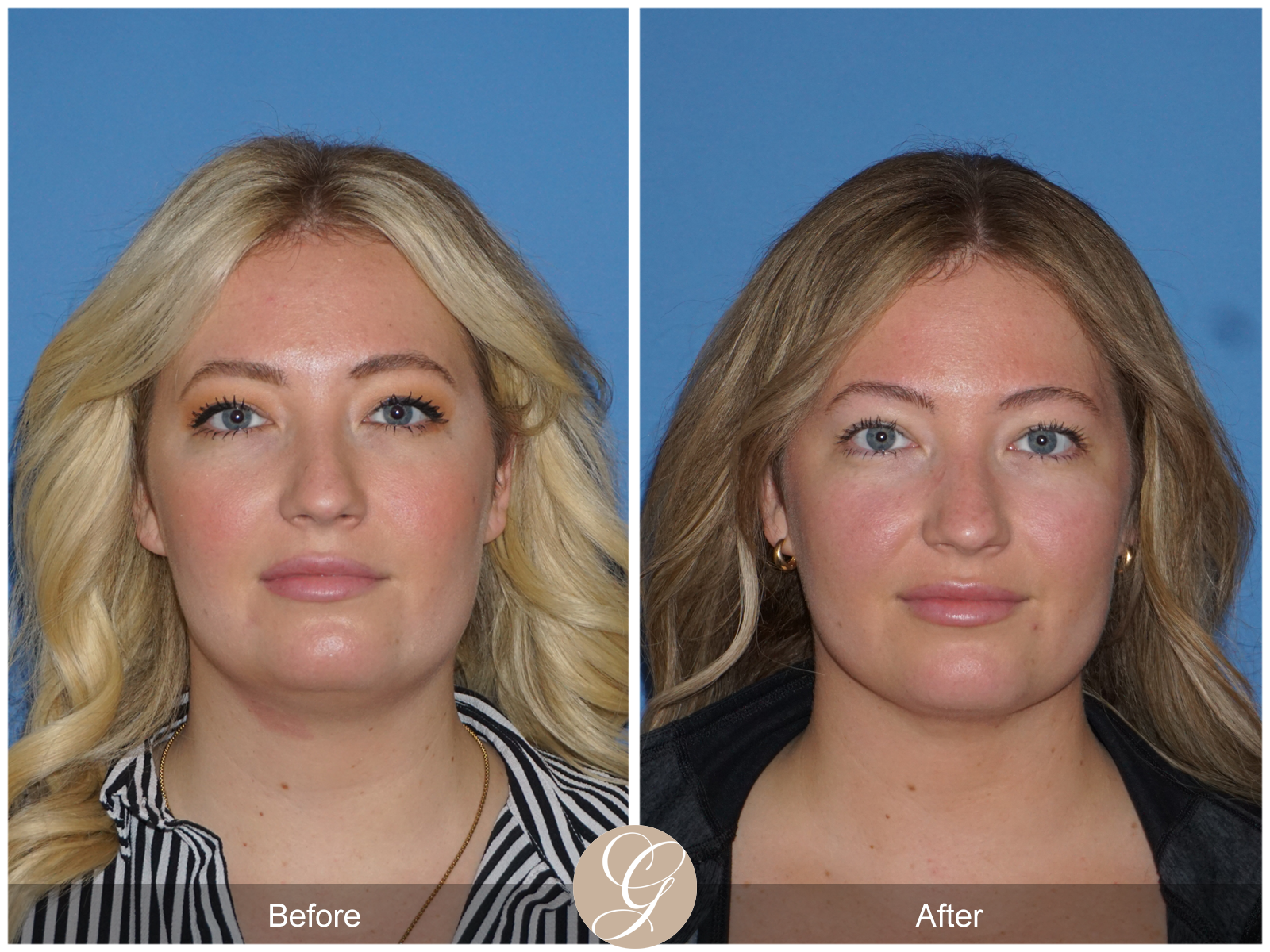 Facial Contouring Case 8 Image