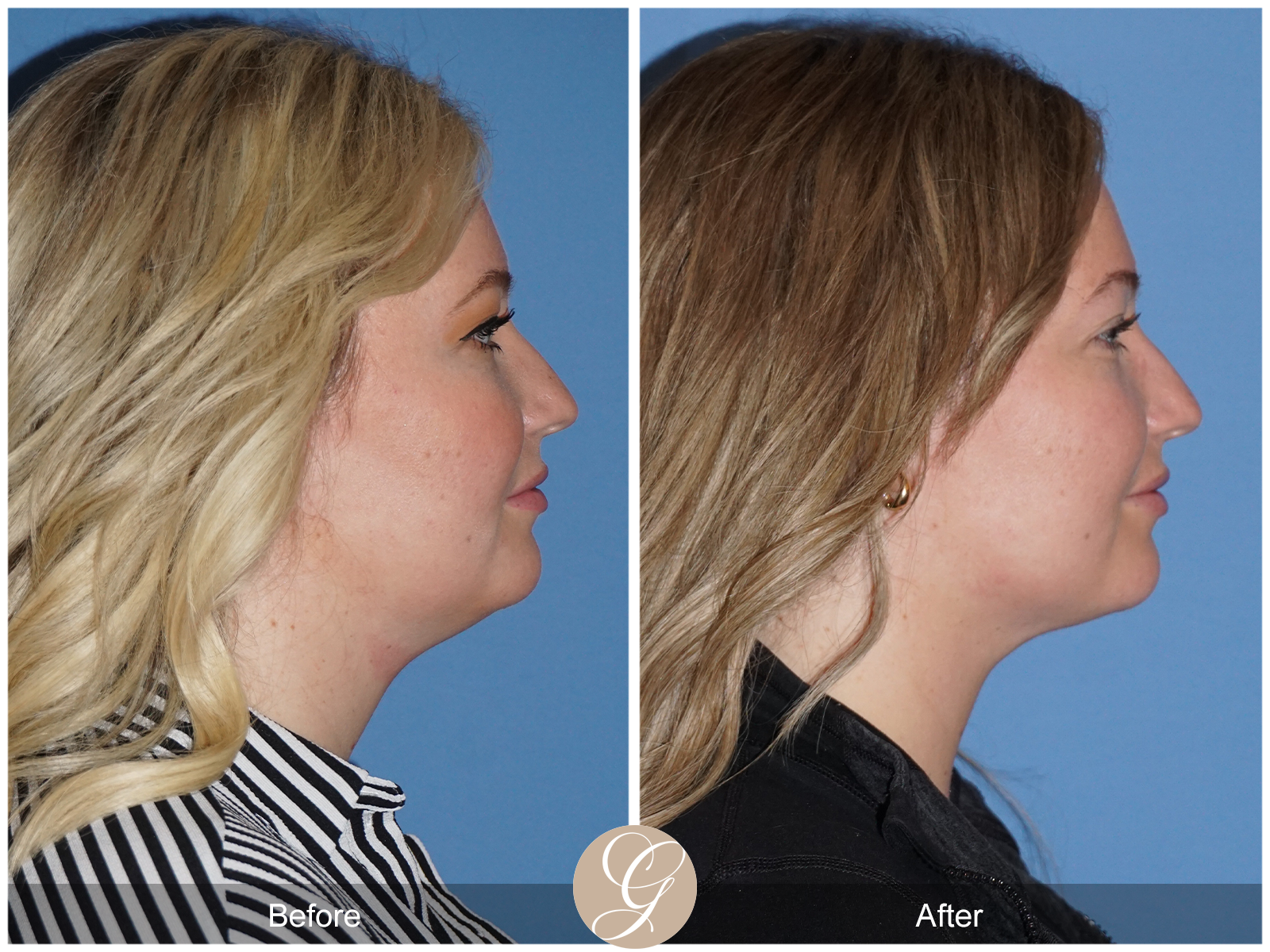 Facial Contouring Case 8 Image