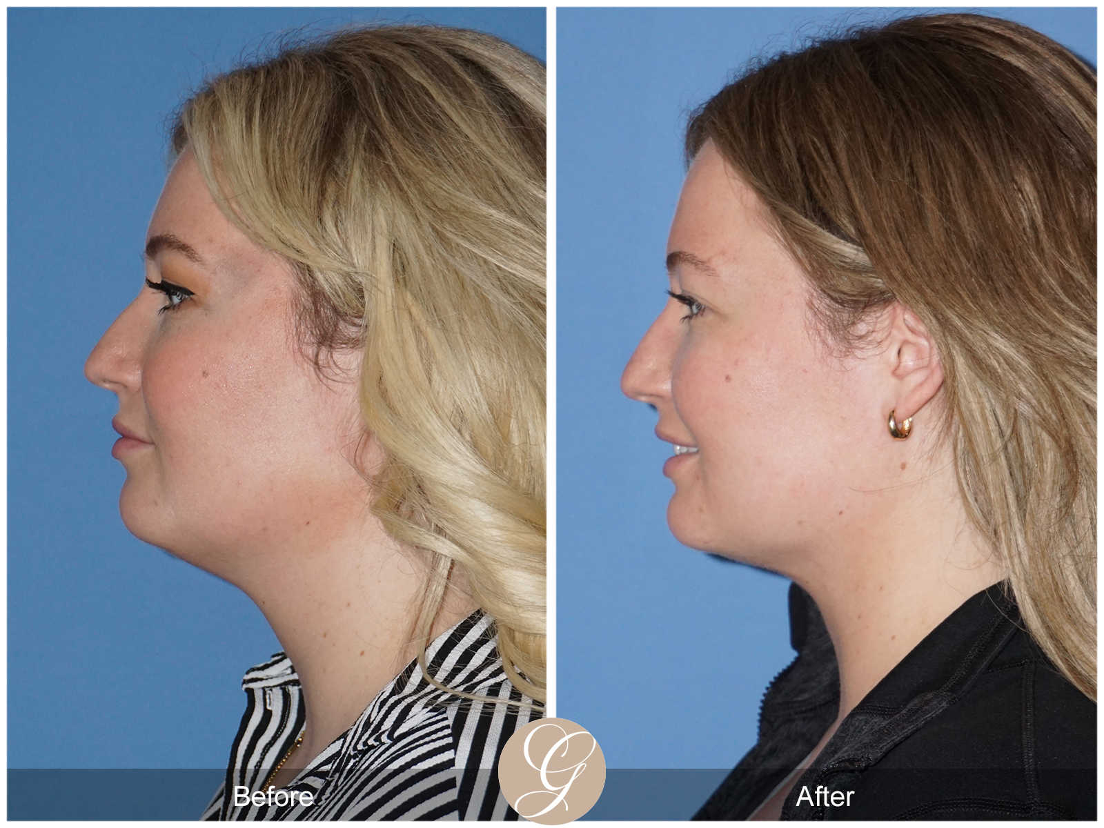 Facial Contouring Case 8 Image