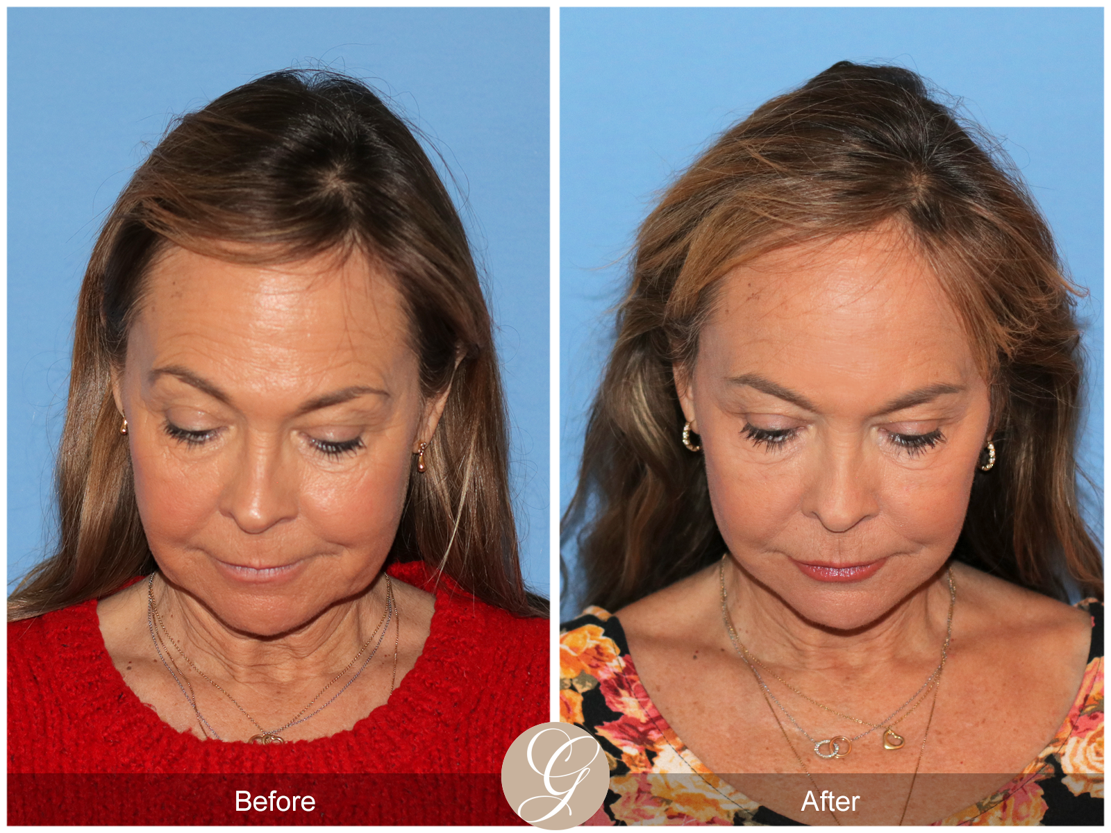 Preservation Deep Plane Facelift Case 45 Image