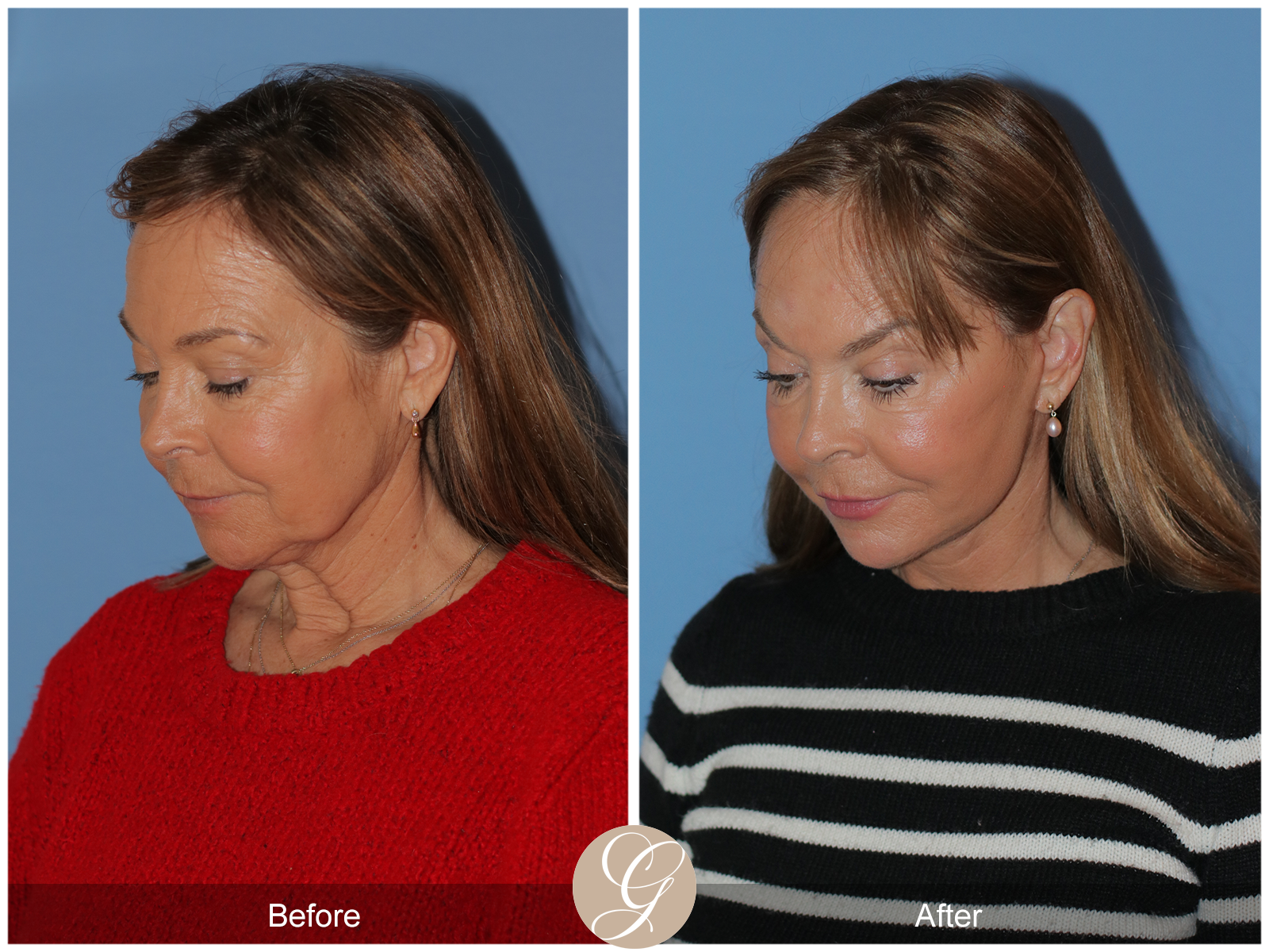 Preservation Deep Plane Facelift Case 45 Image