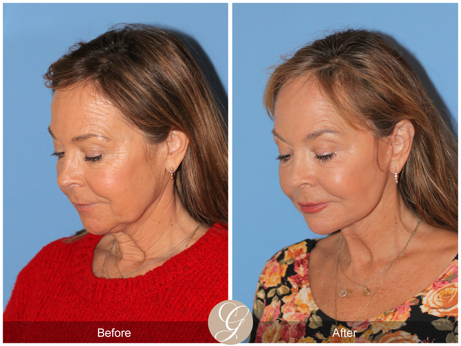 Preservation Deep Plane Facelift Case 45 Image