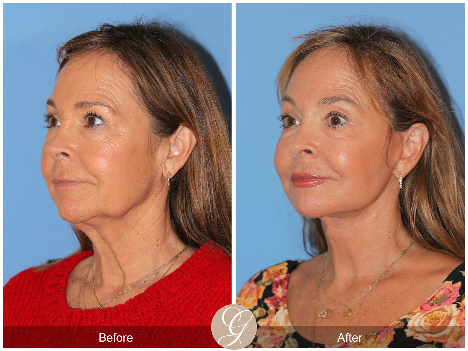 Preservation Deep Plane Facelift Case 45 Image