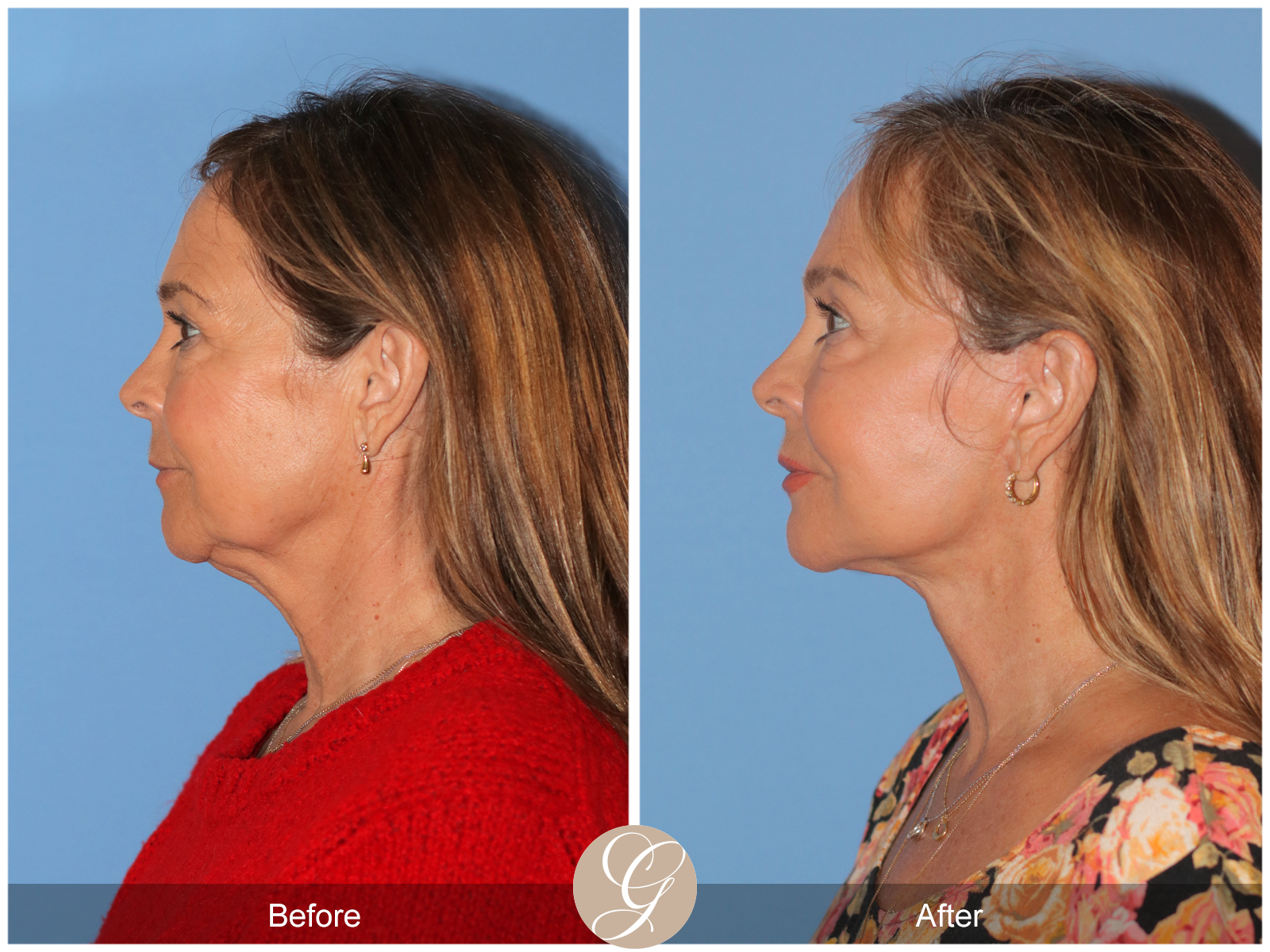 Preservation Deep Plane Facelift Case 45 Image