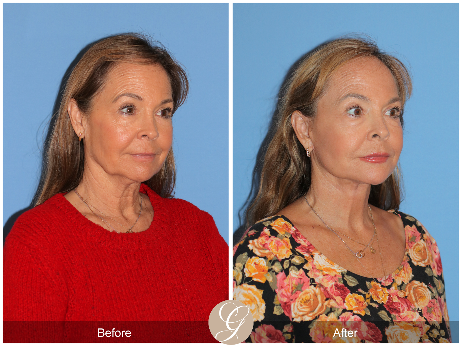 Preservation Deep Plane Facelift Case 45 Image