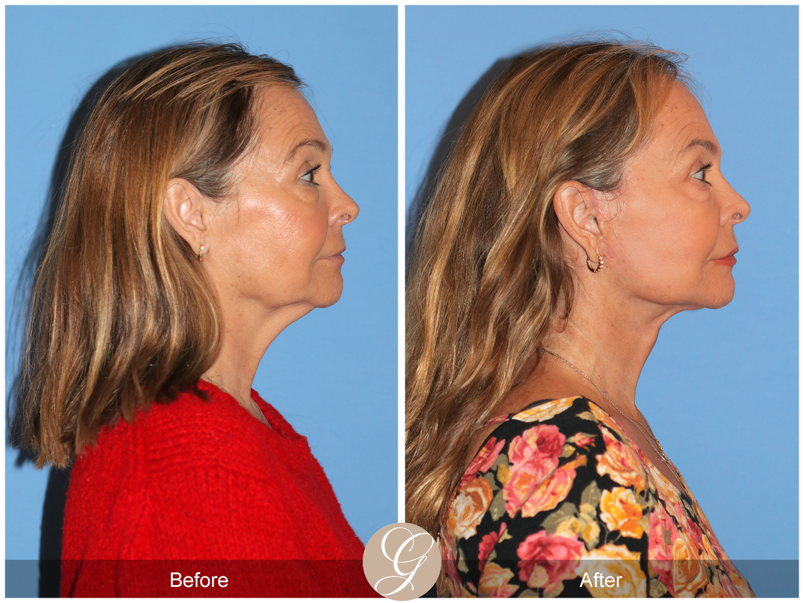 Preservation Deep Plane Facelift Case 45 Image