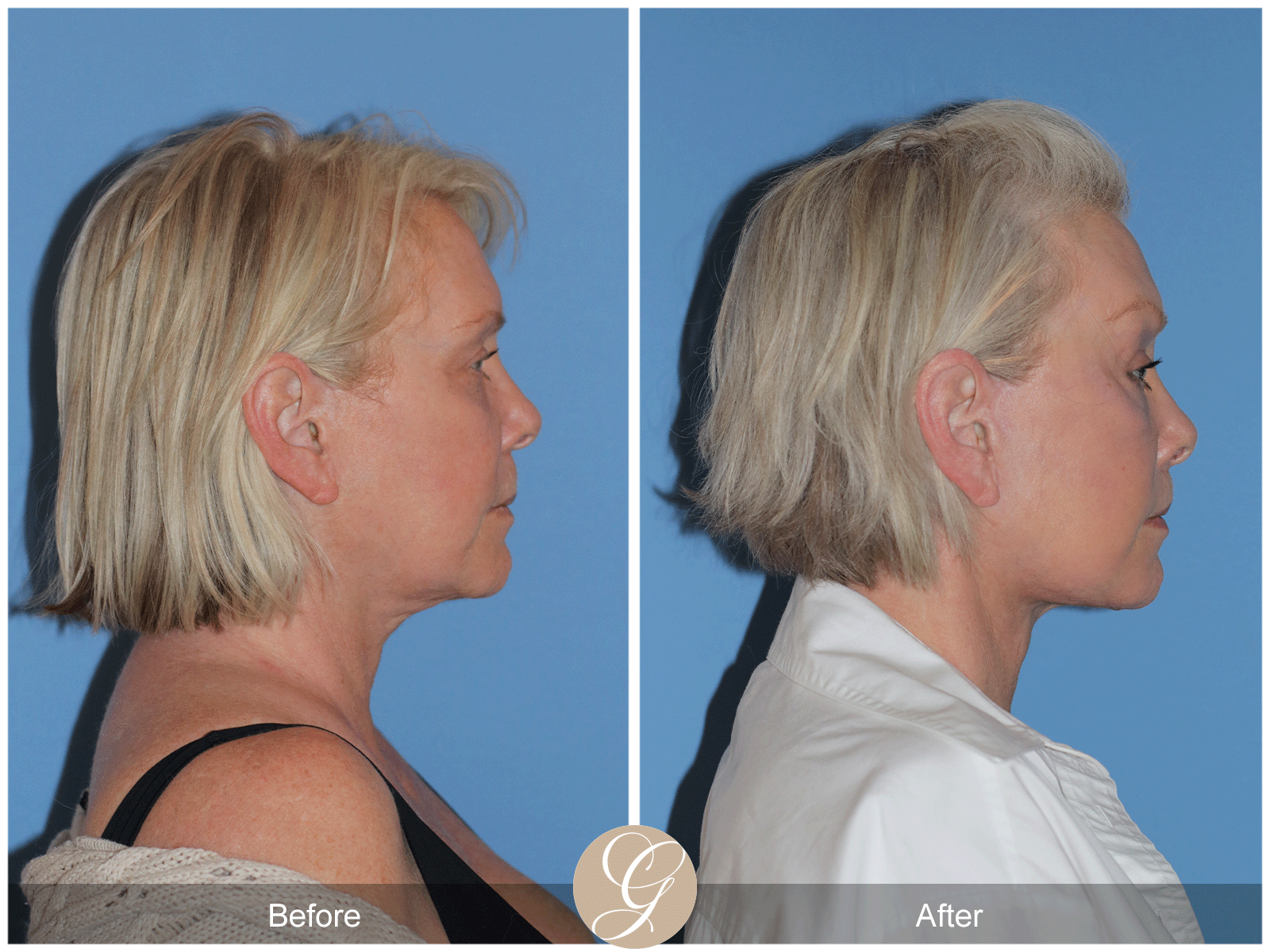 Preservation Deep Plane Facelift Case 48 Image