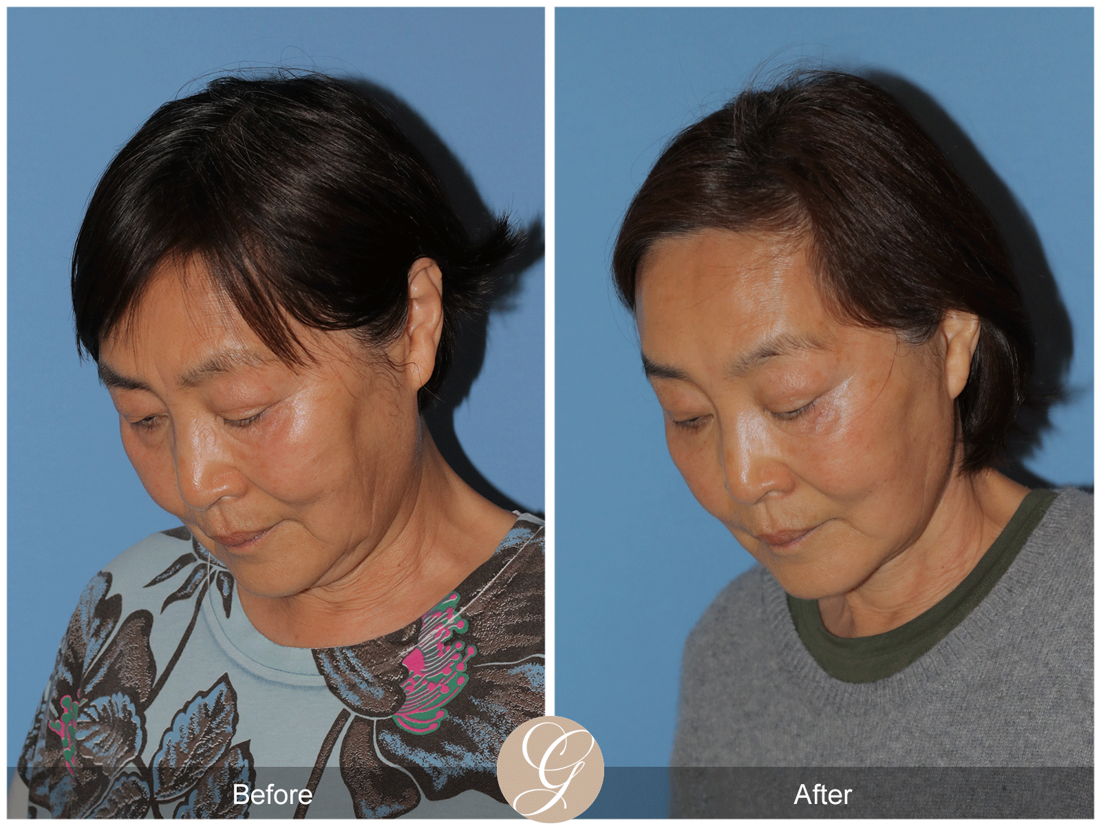 Deep Plane Facelift Case 45 Image