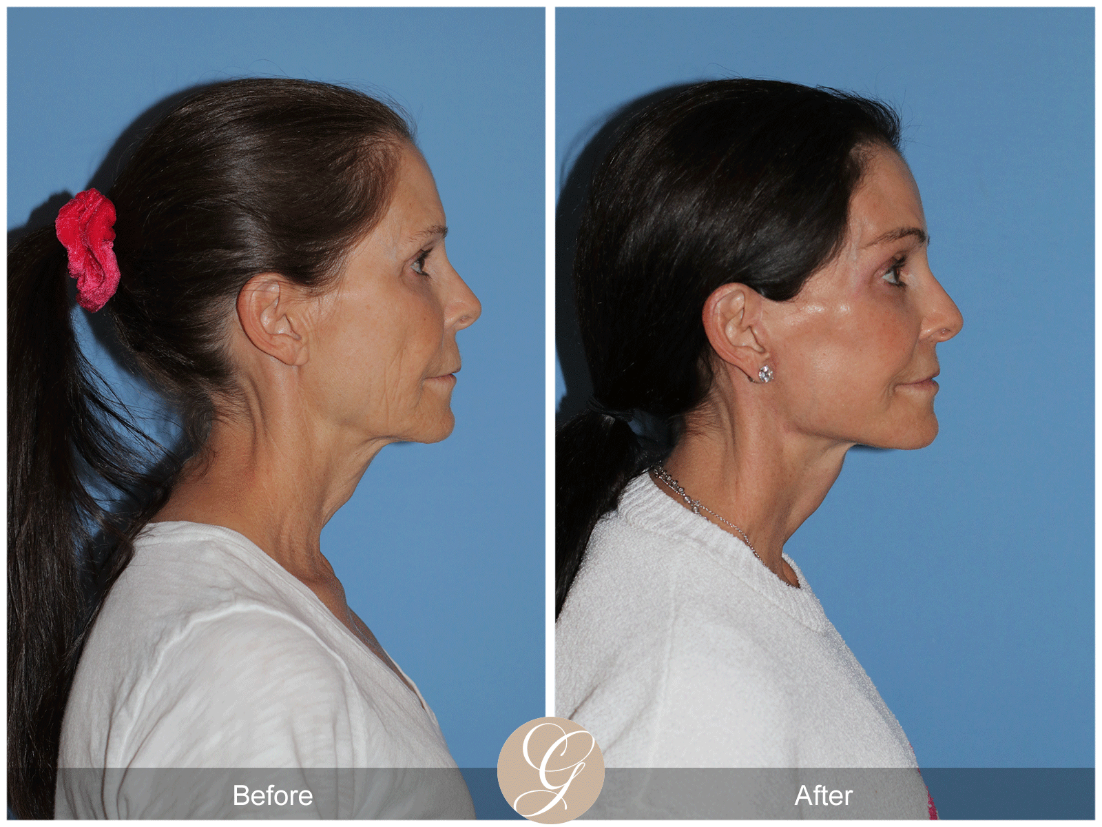 Deep Plane Facelift Case 46 Image