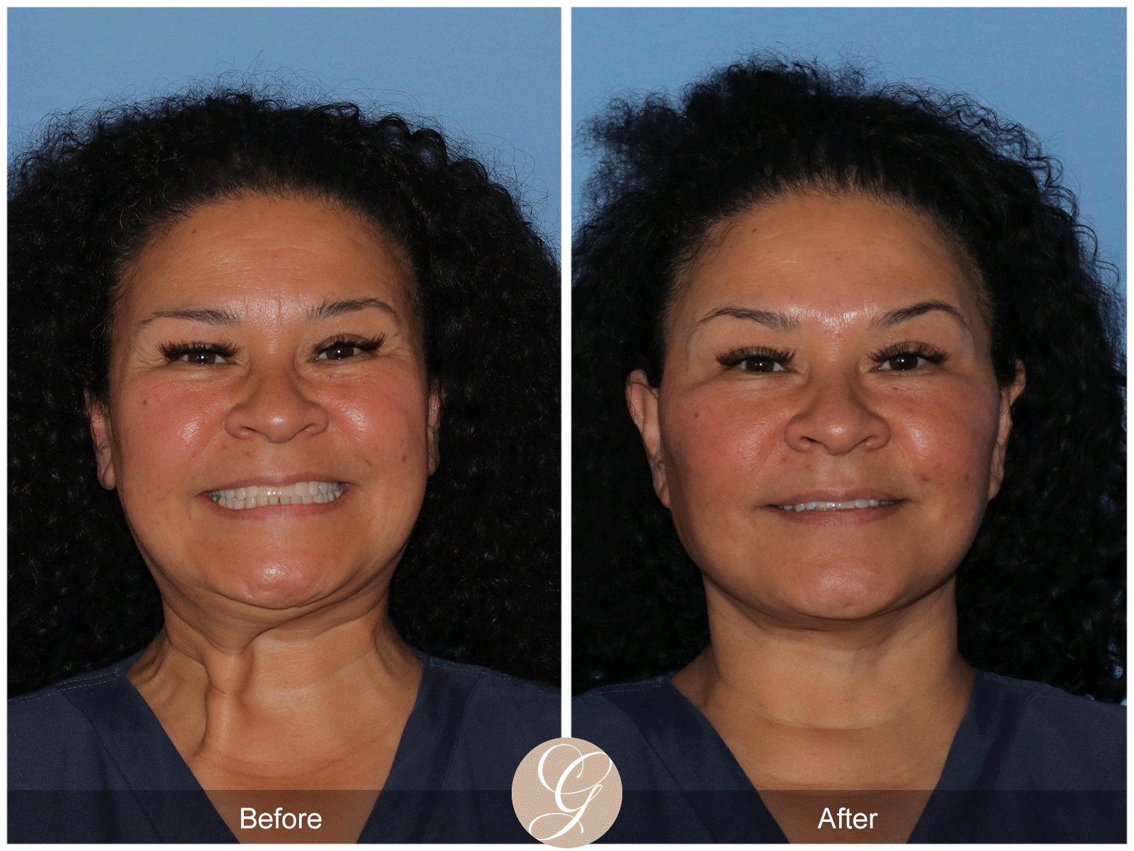 Deep Plane Facelift Case 40 Image