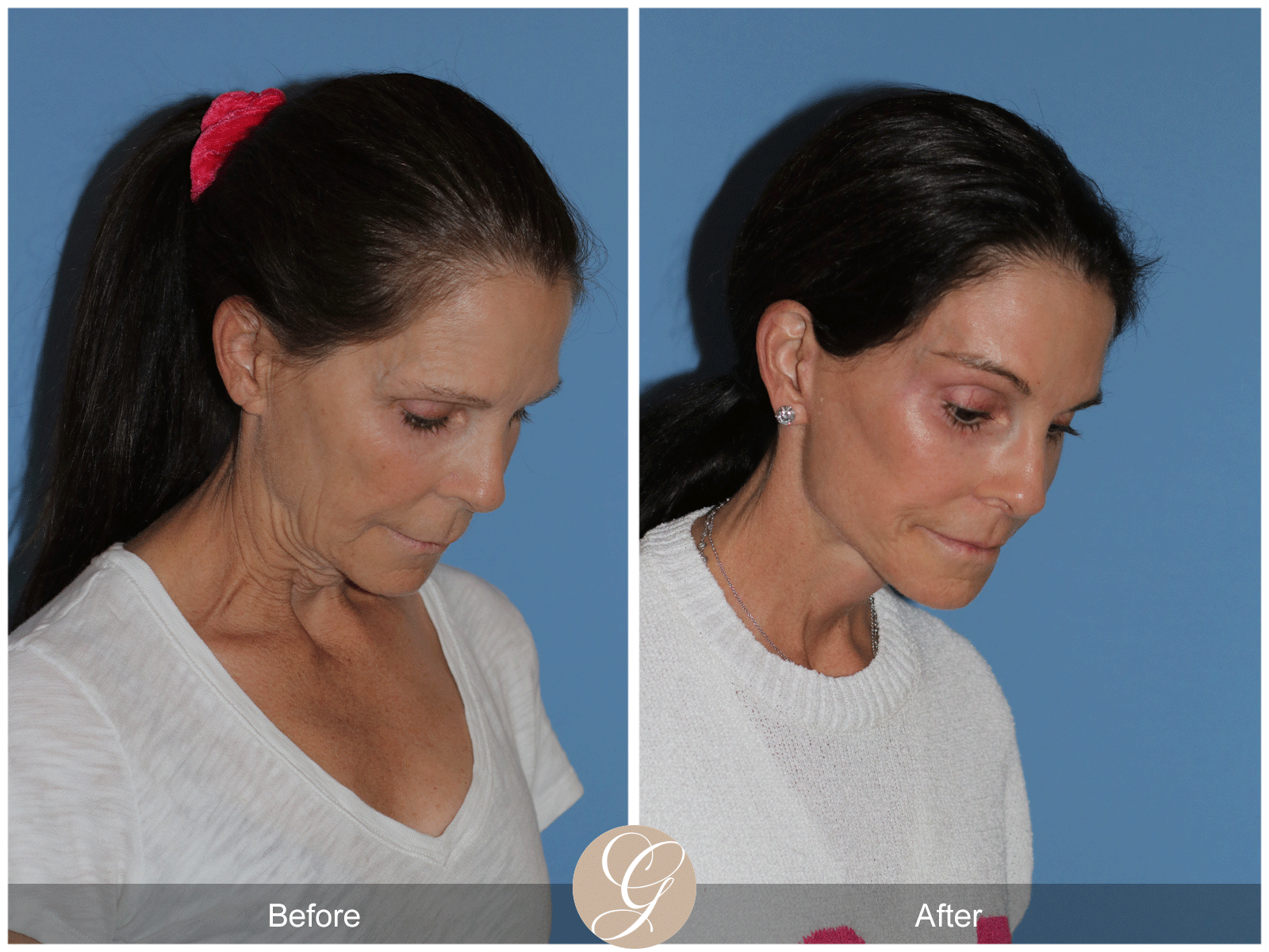 Deep Plane Facelift Case 46 Image