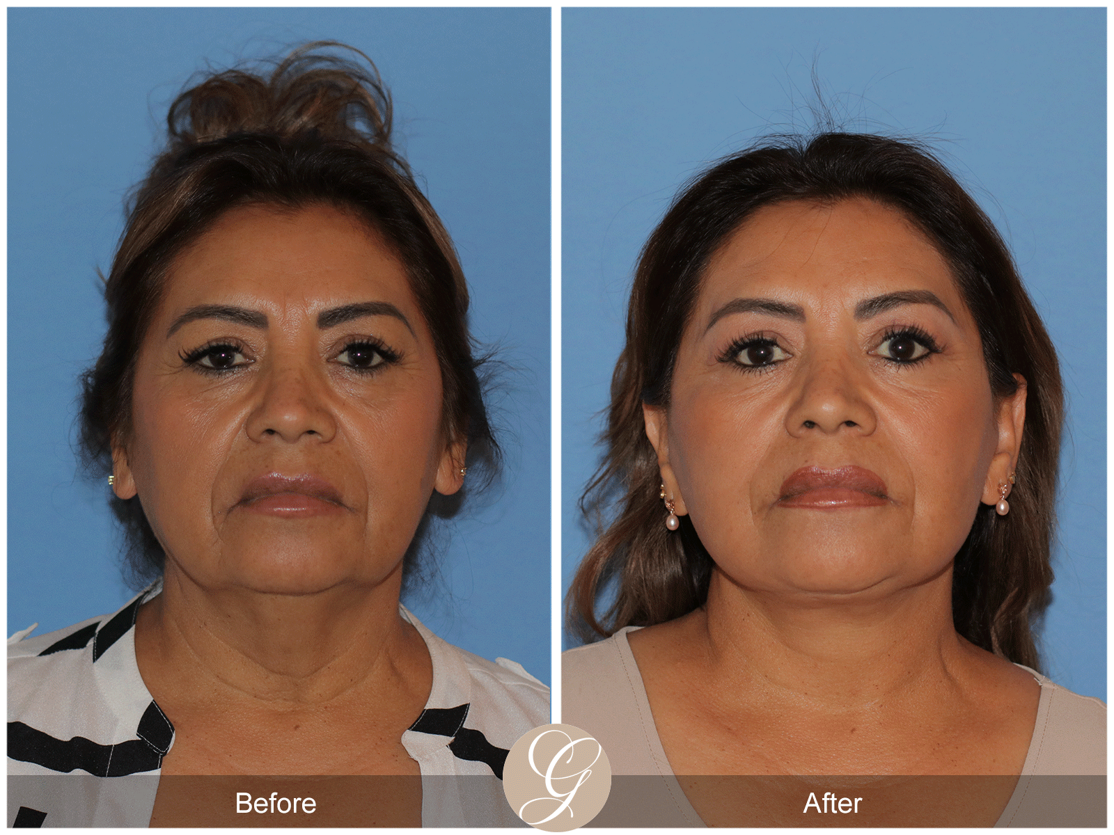 Preservation Deep Plane Facelift Case 41 Image