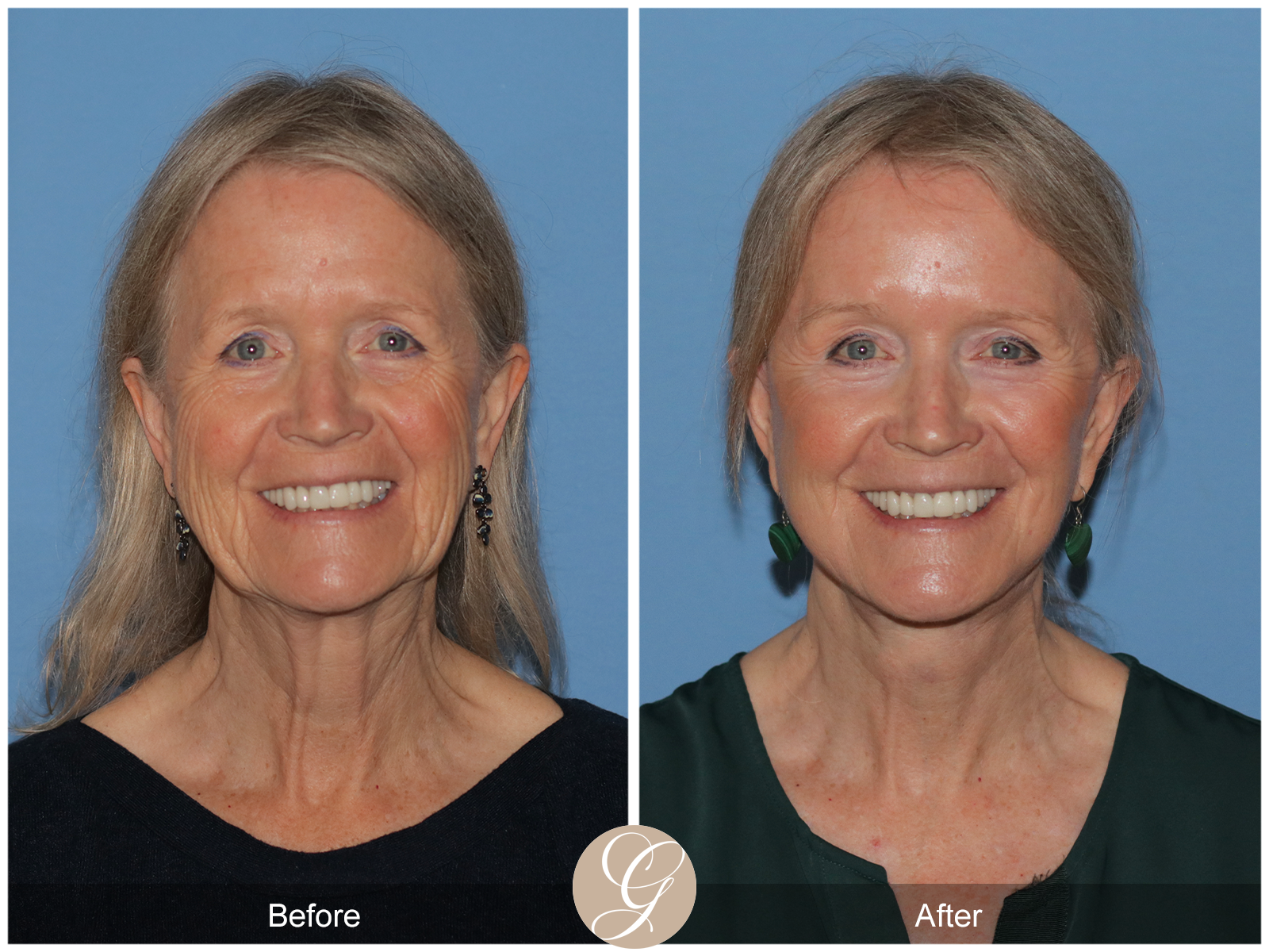 Preservation Deep Plane Facelift Case 42 Image