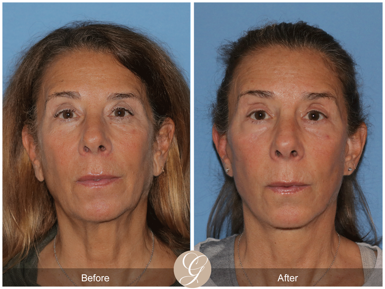 Preservation Deep Plane Facelift Case 43 Image