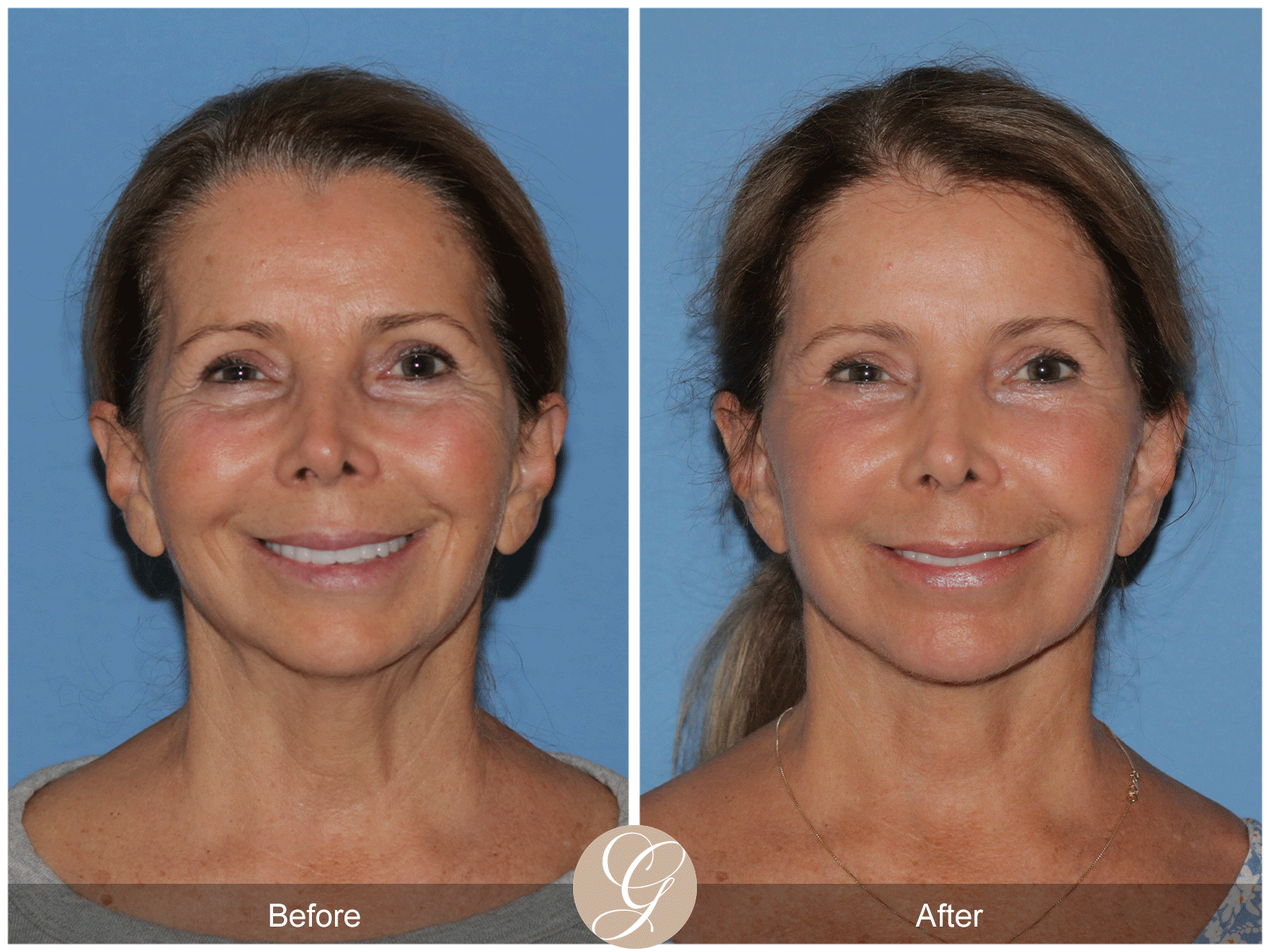 Preservation Deep Plane Facelift Case 44 Image