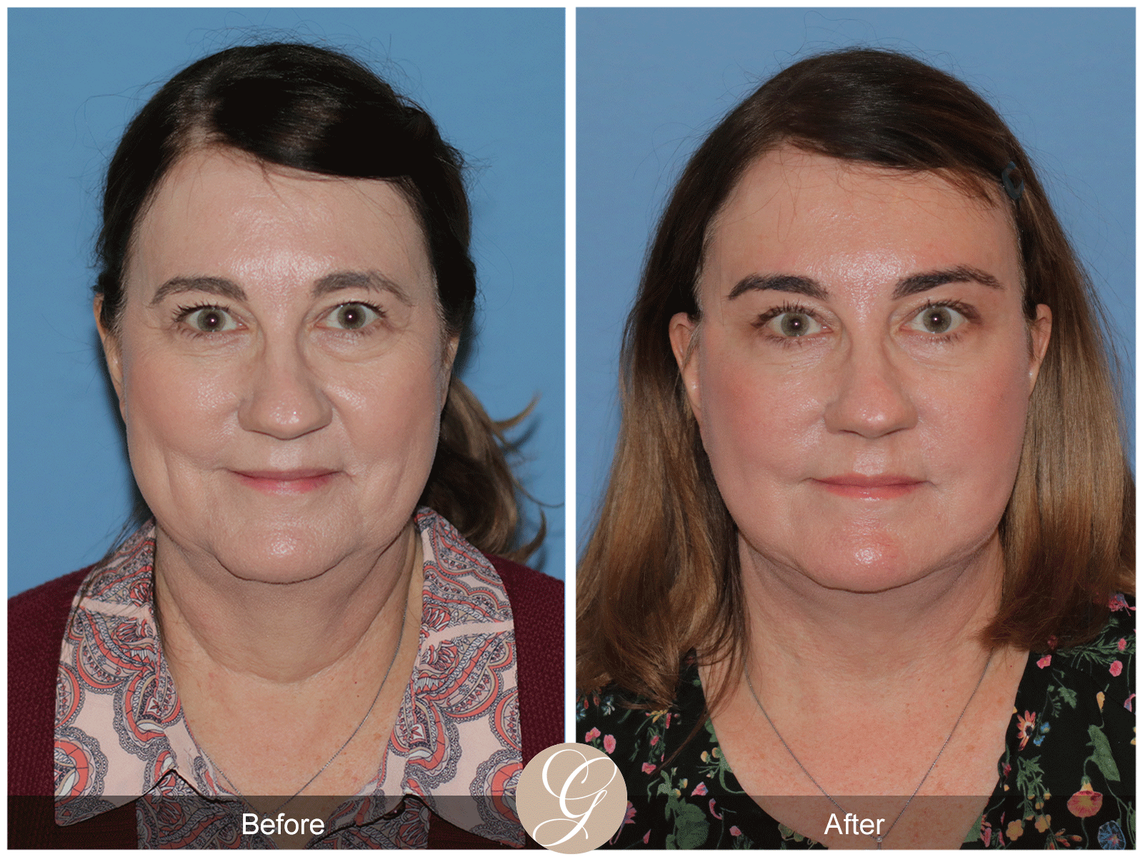 Deep Plane Facelift Case 43 Image