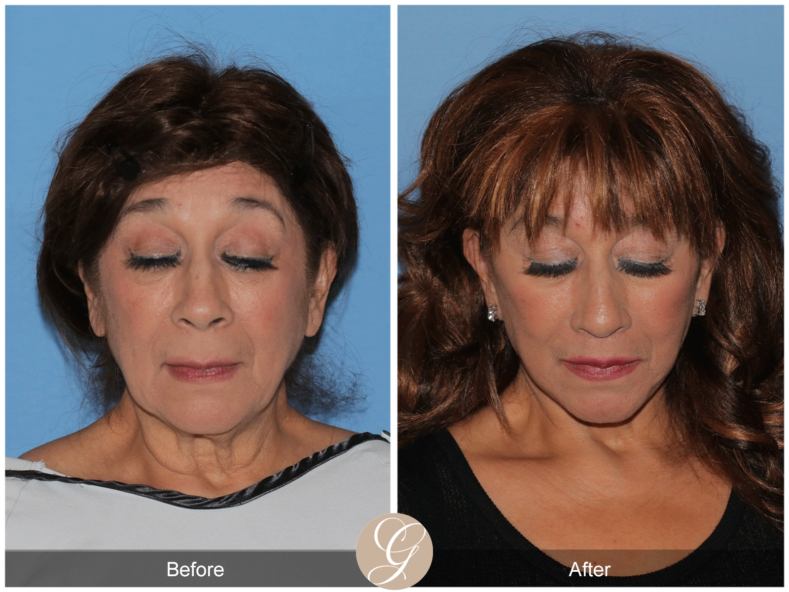 Deep Plane Facelift Case 44 Image