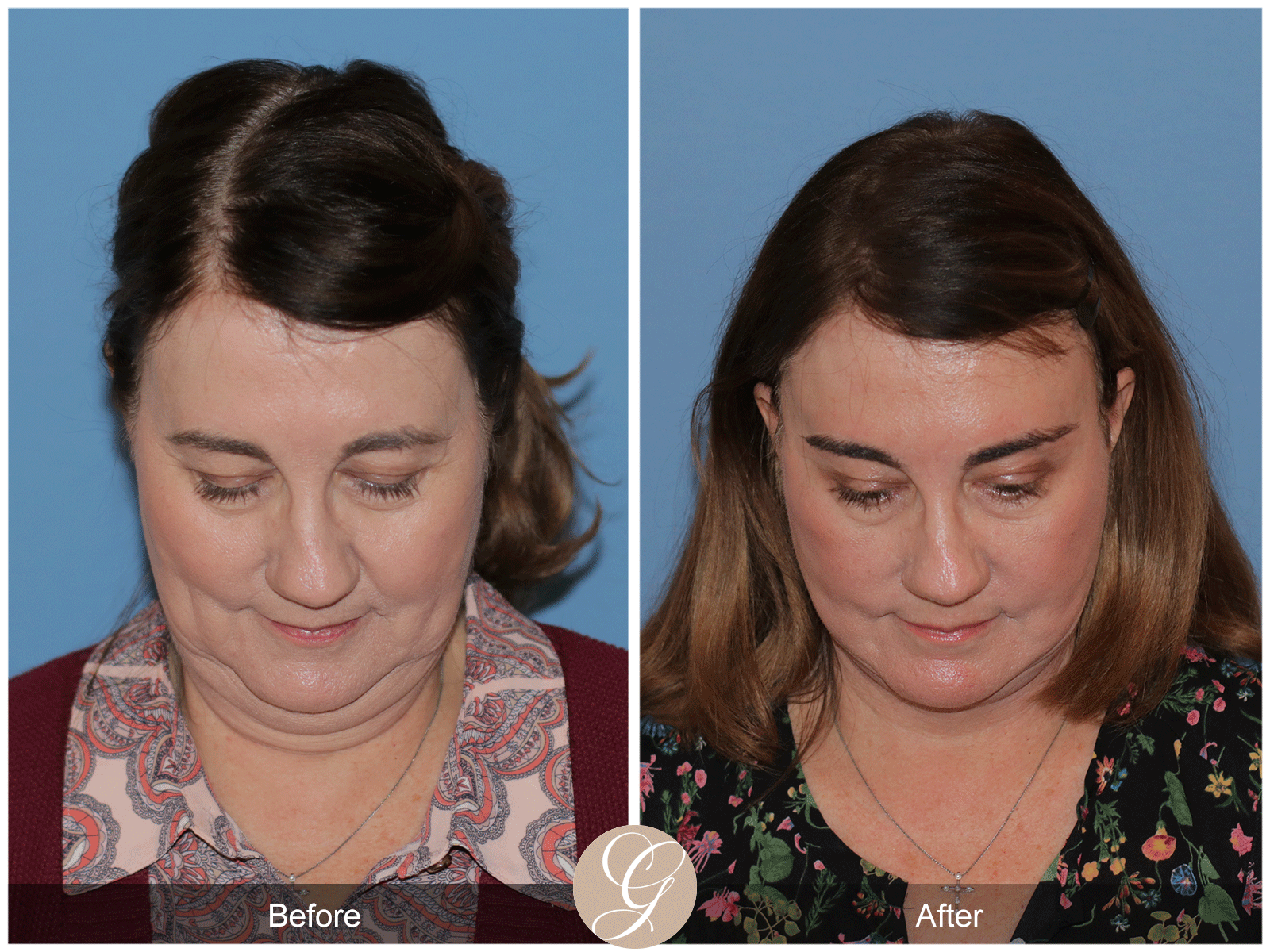 Deep Plane Facelift Case 43 Image