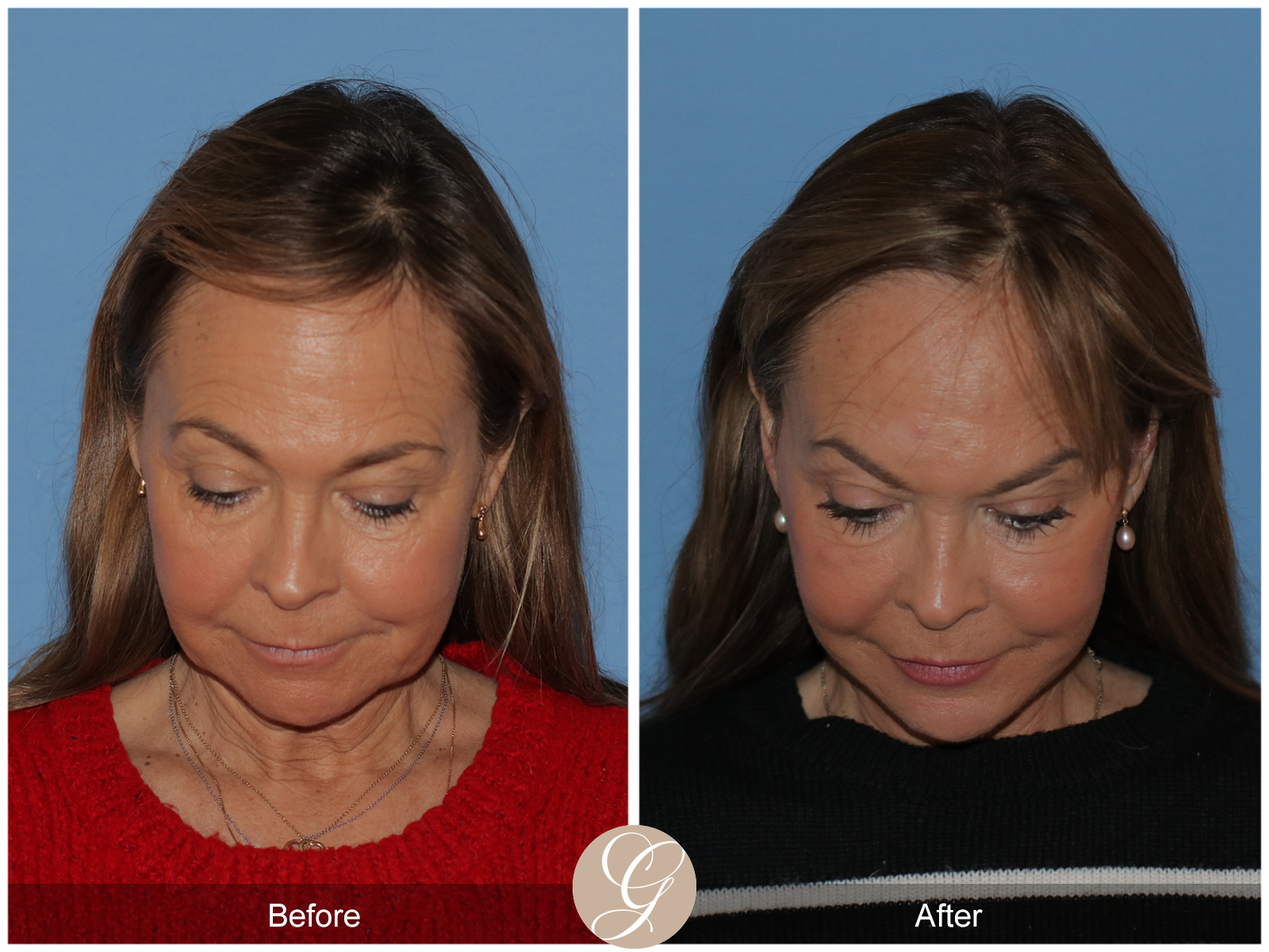 Preservation Deep Plane Facelift Case 45 Image