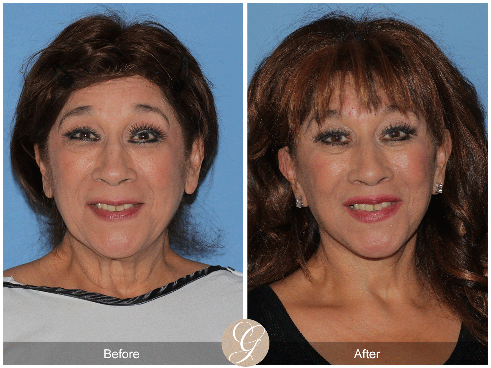 Deep Plane Facelift Case 44 Image