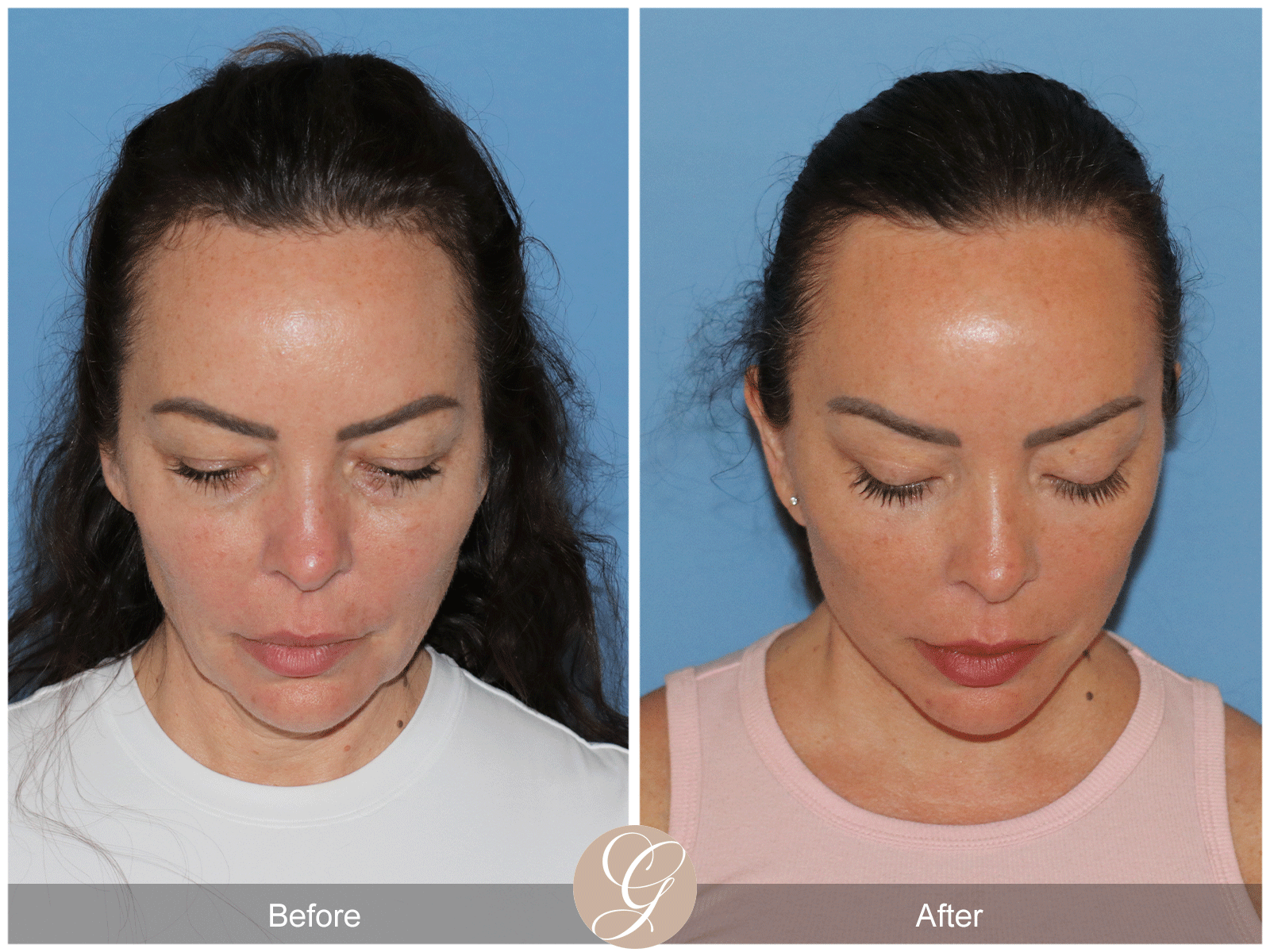 Preservation Deep Plane Facelift Case 46 Image