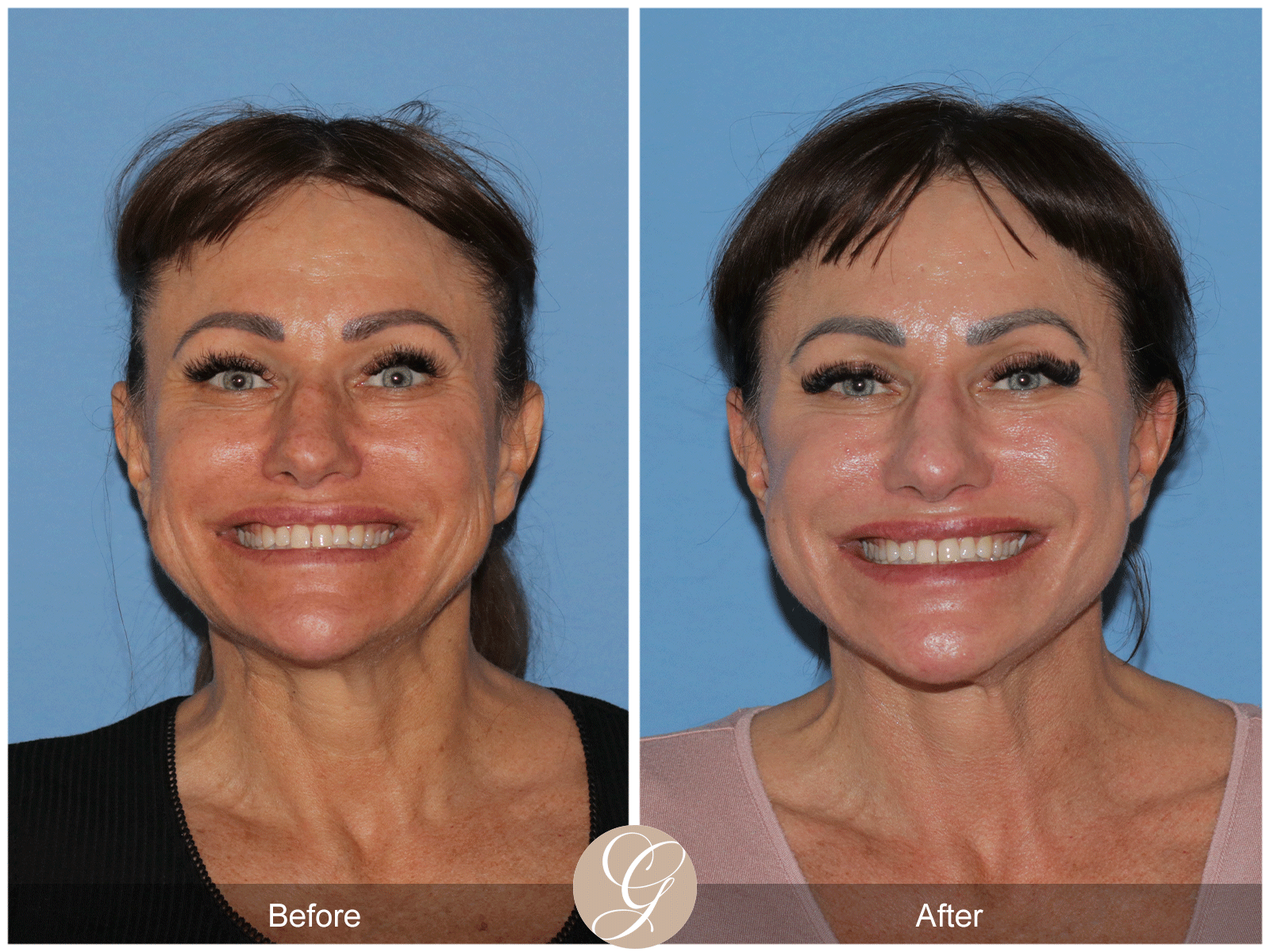 Preservation Deep Plane Facelift Case 47 Image