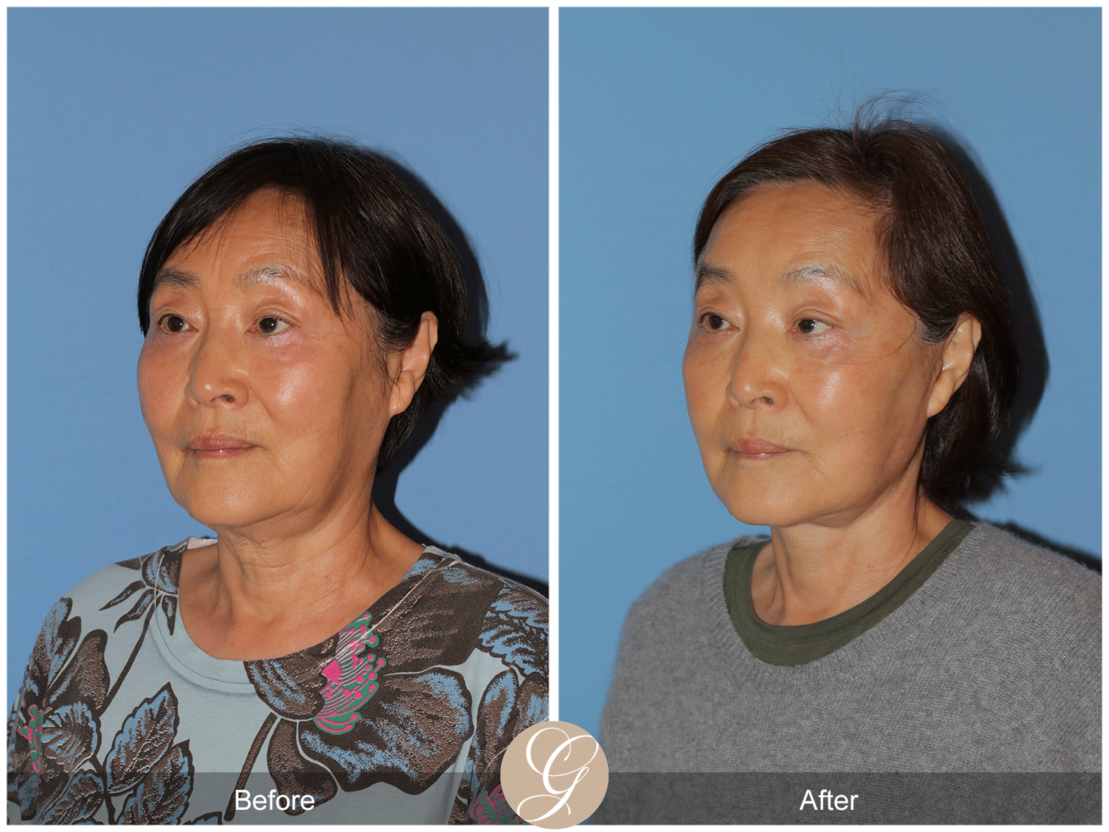 Deep Plane Facelift Case 45 Image