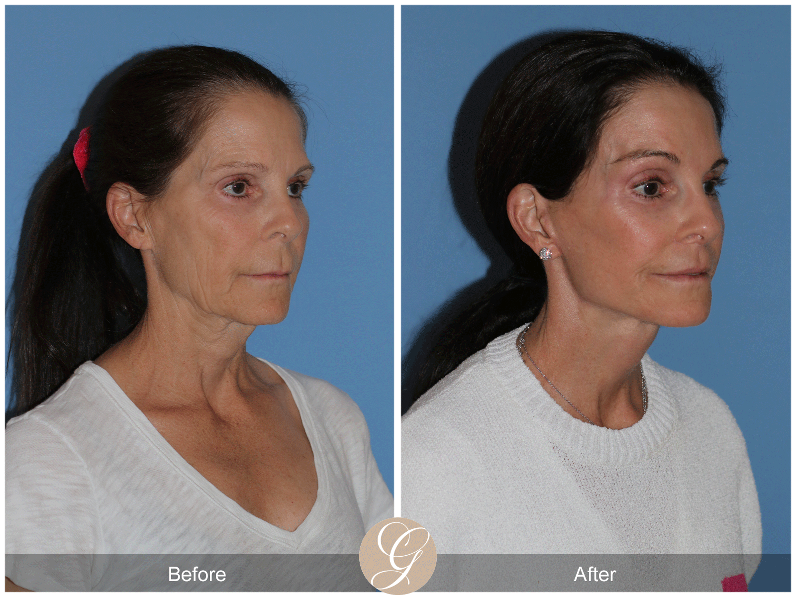 Deep Plane Facelift Case 46 Image