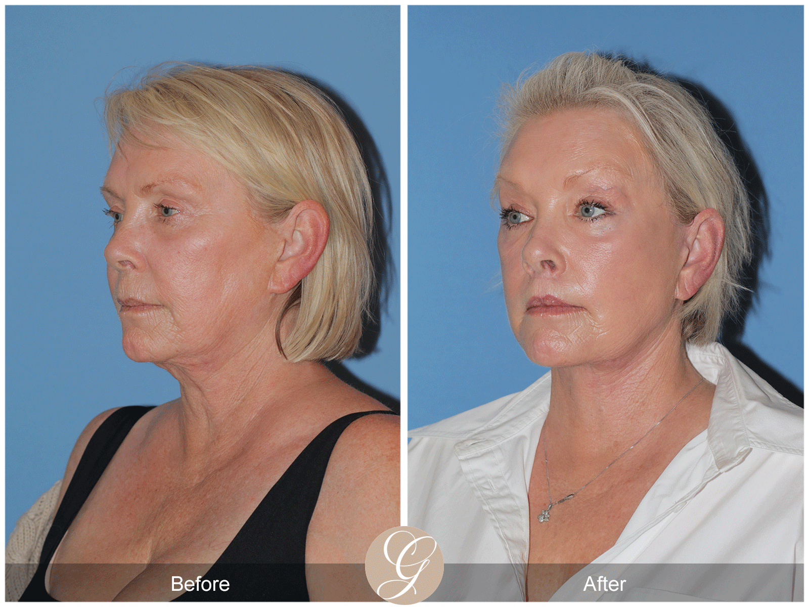 Preservation Deep Plane Facelift Case 48 Image