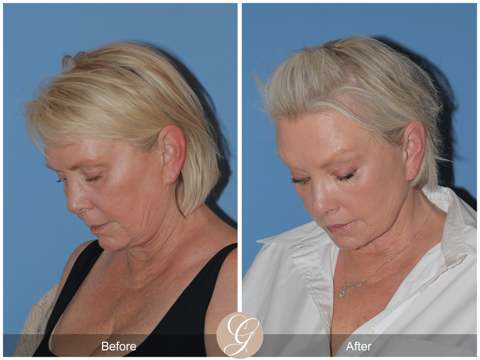 Preservation Deep Plane Facelift Case 48 Image