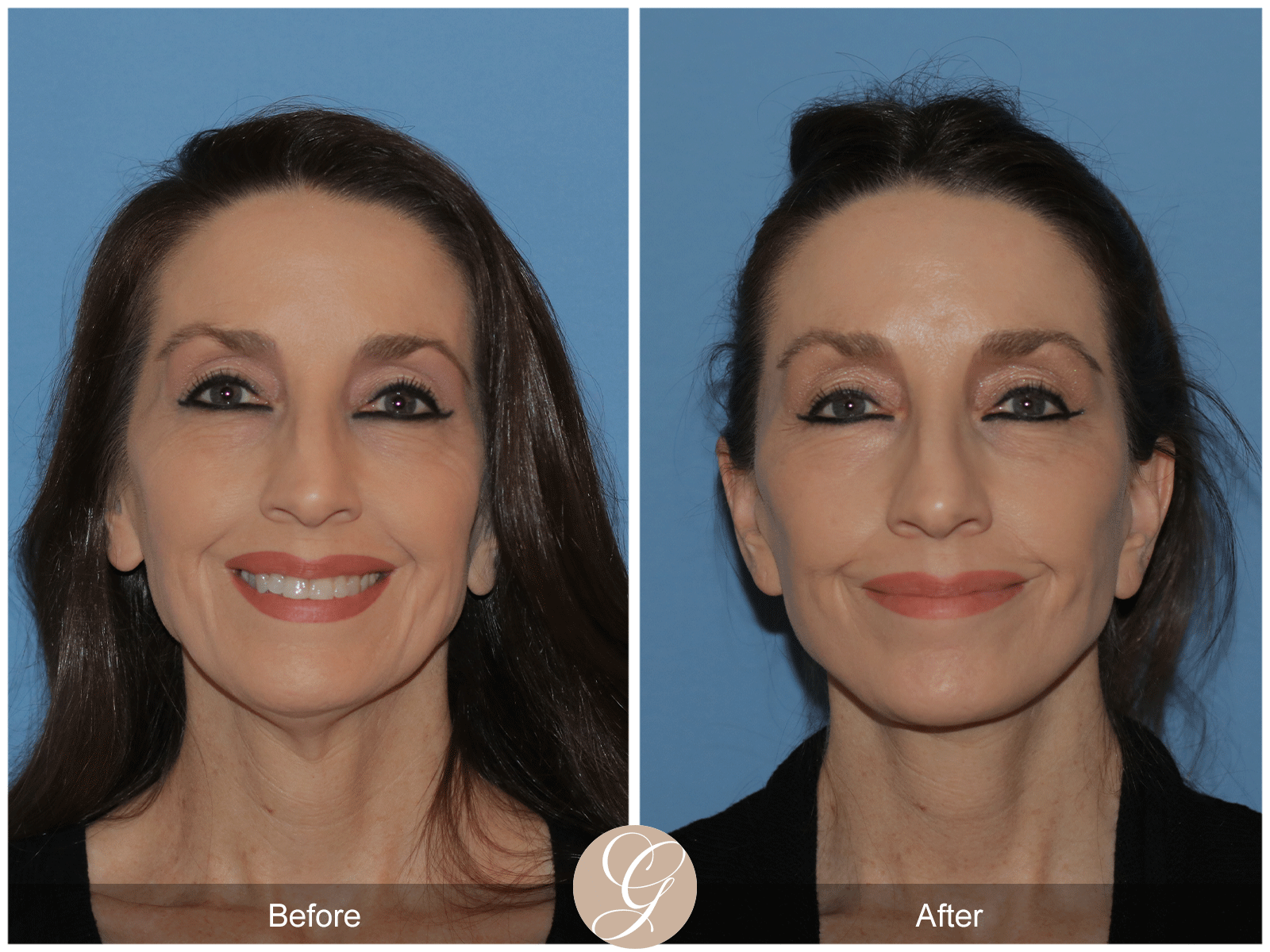 Deep Plane Facelift Case 38 Image