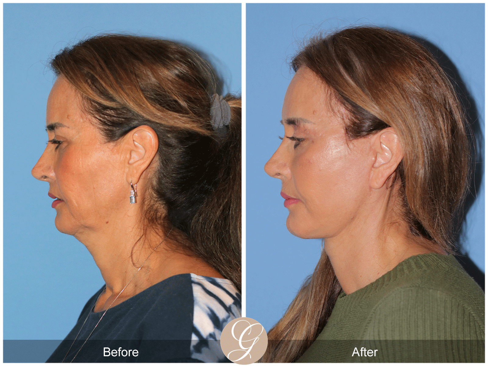 Preservation Deep Plane Facelift Case 49 Image