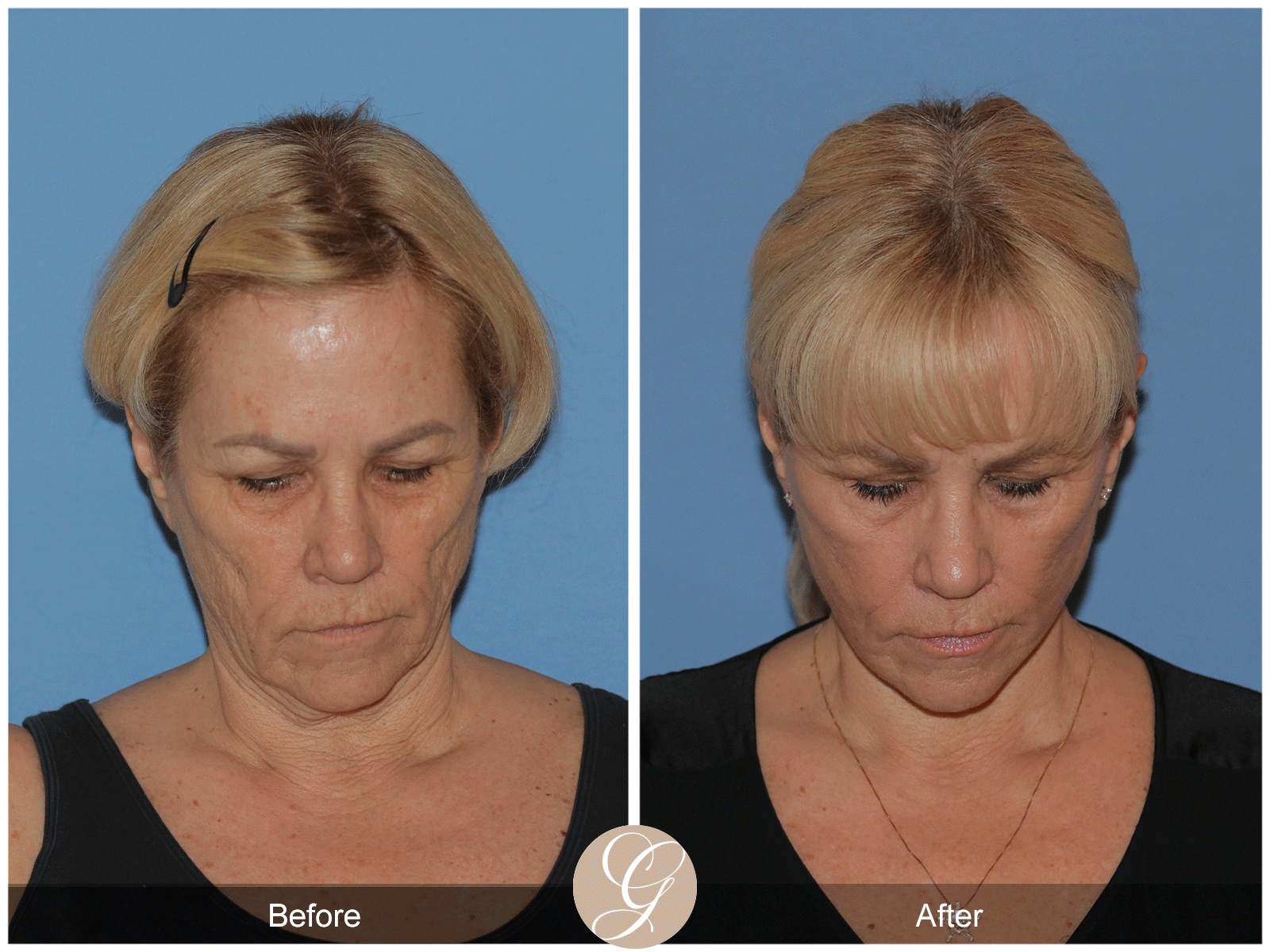 Deep Plane Facelift Case 38 Image