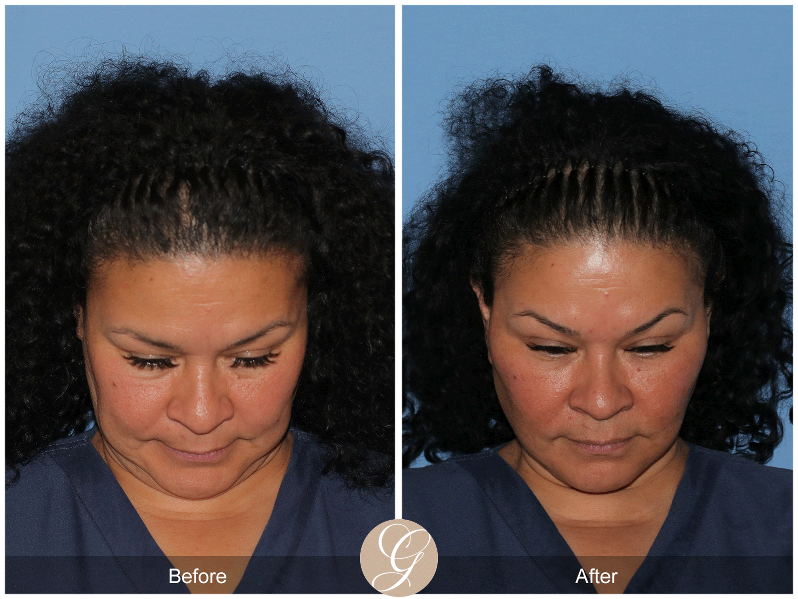 Deep Plane Facelift Case 40 Image